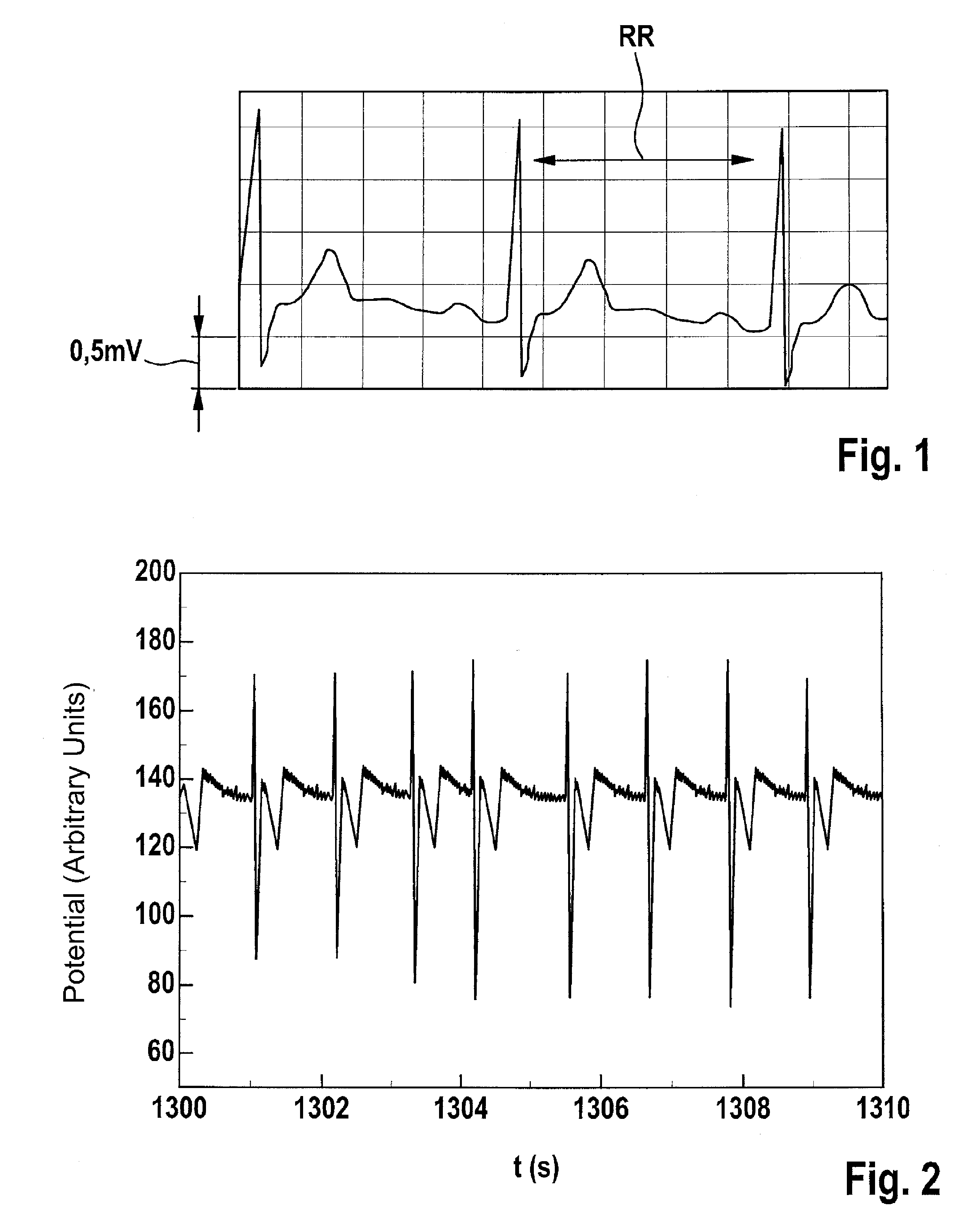 Diagnosis of sleep apnea