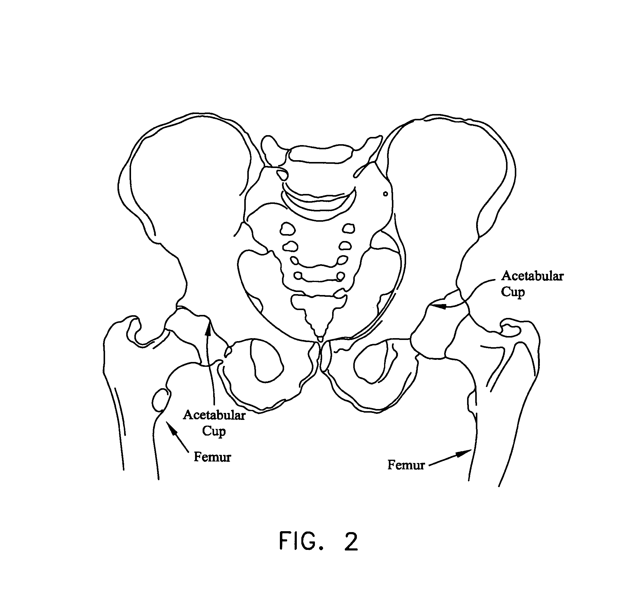 Safety needle for accessing the interior of a hip joint