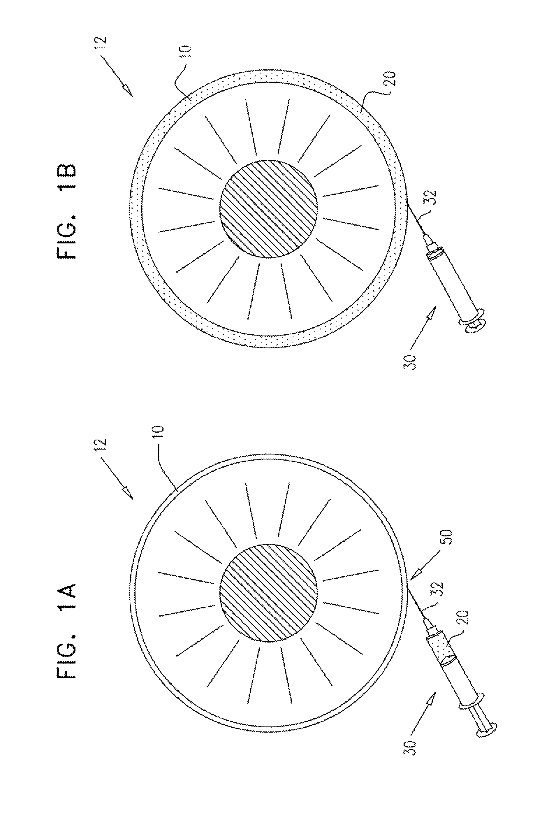 Injectable hydrogel implant for treating glaucoma