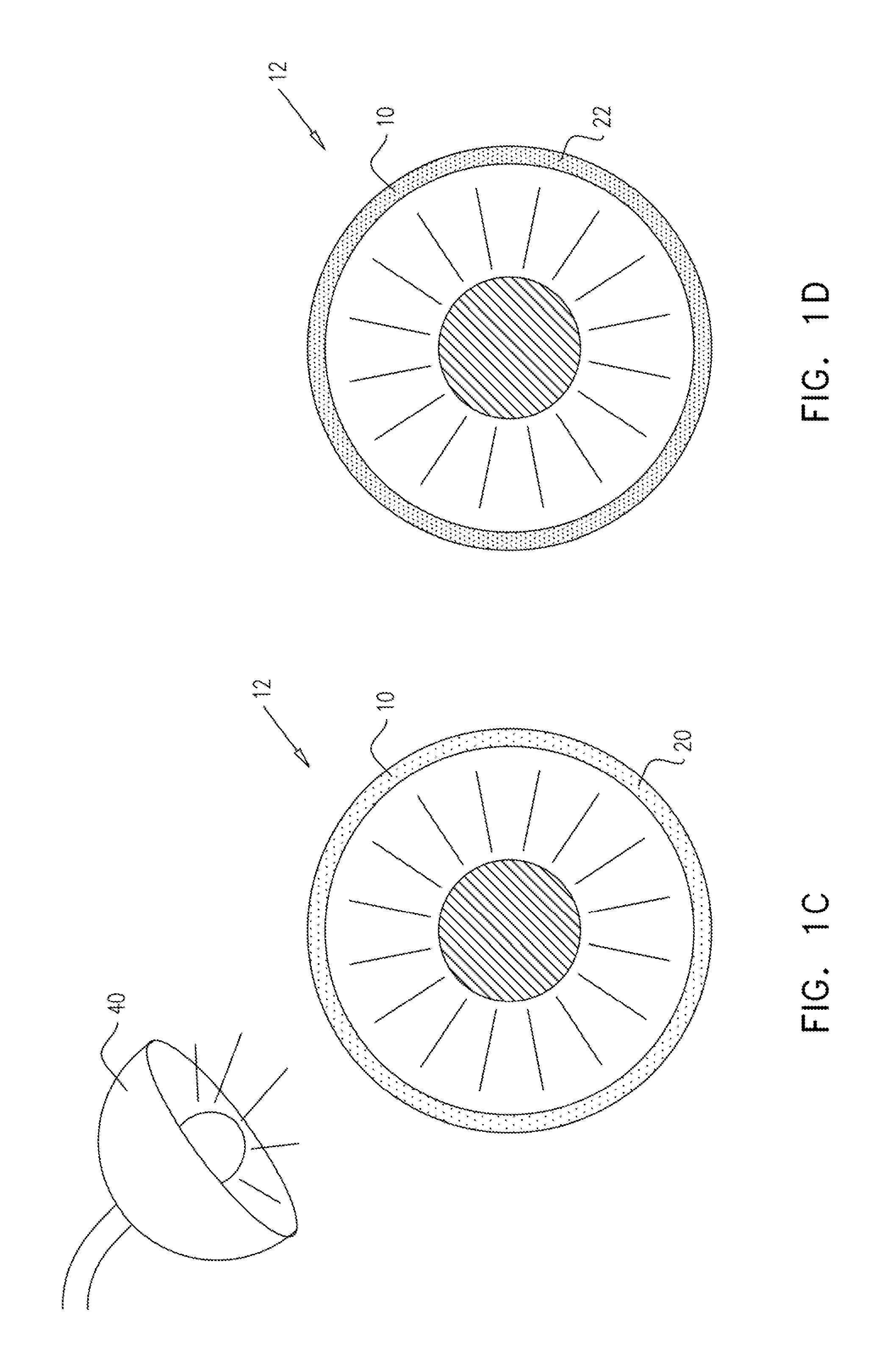 Injectable hydrogel implant for treating glaucoma