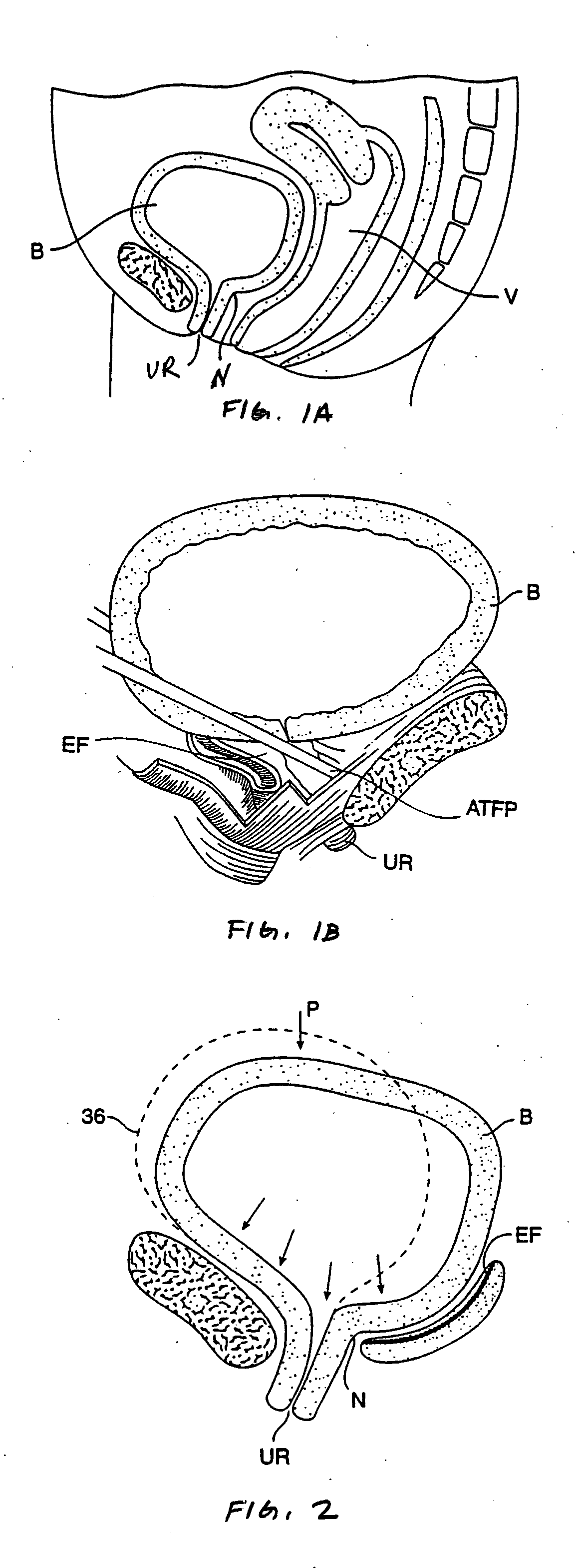 Endo-pelvic fascia penetrating heating systems and methods for incontinence treatment