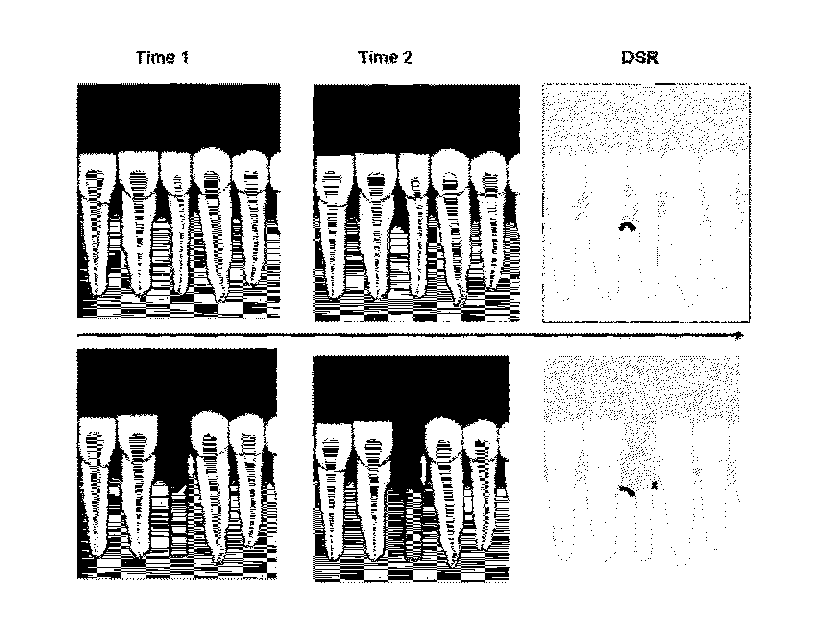 Method for quantifying local bone changes