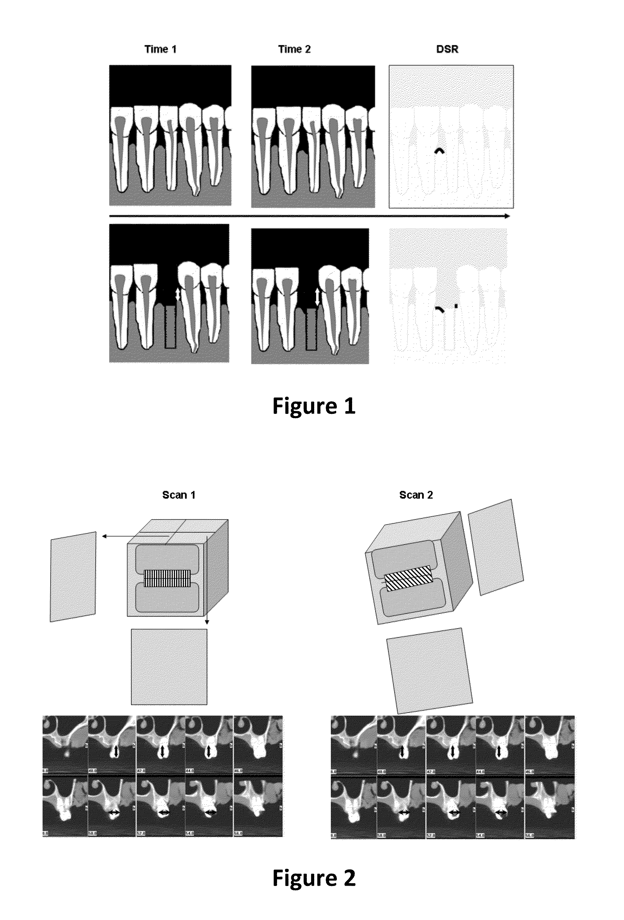 Method for quantifying local bone changes