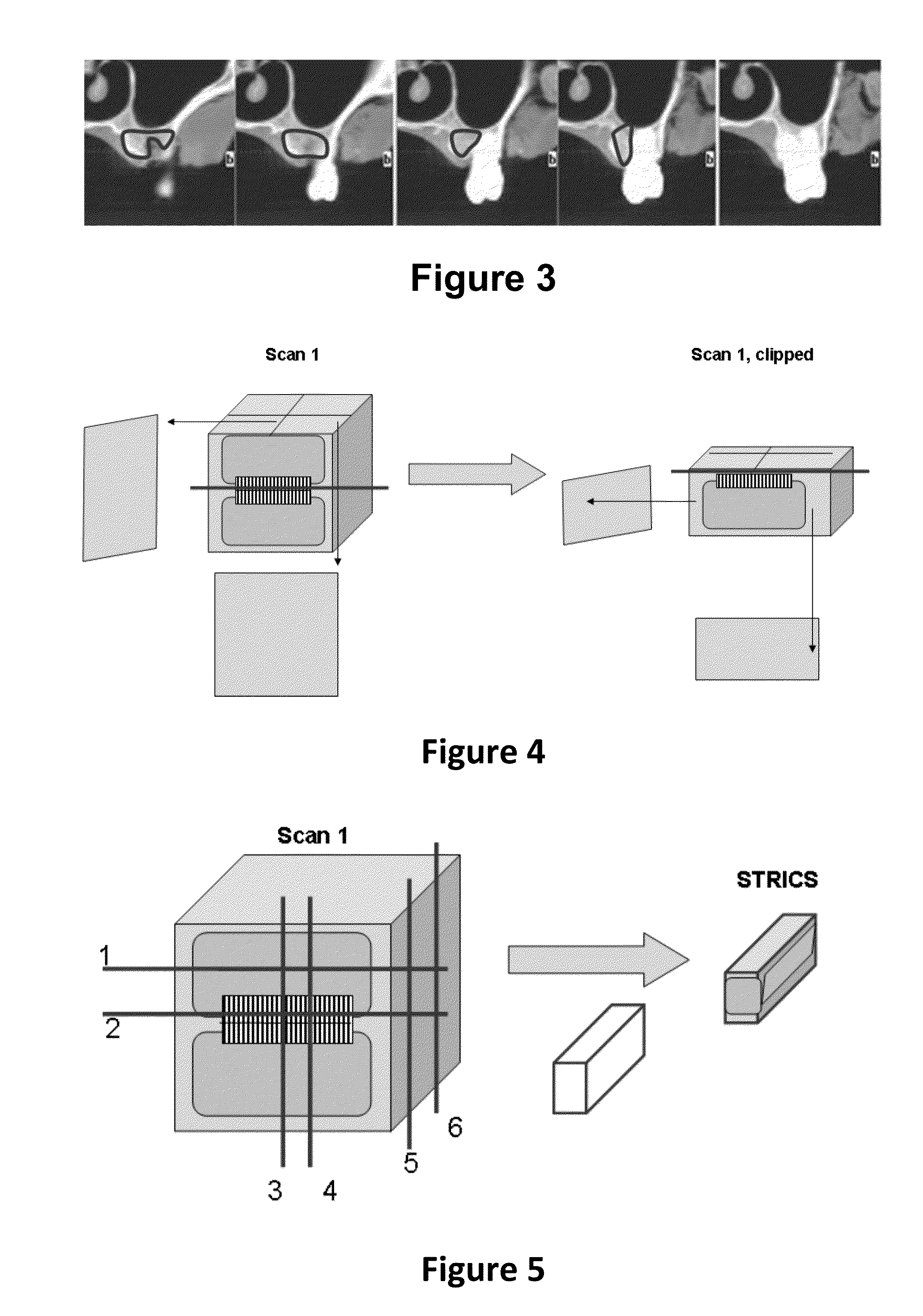 Method for quantifying local bone changes