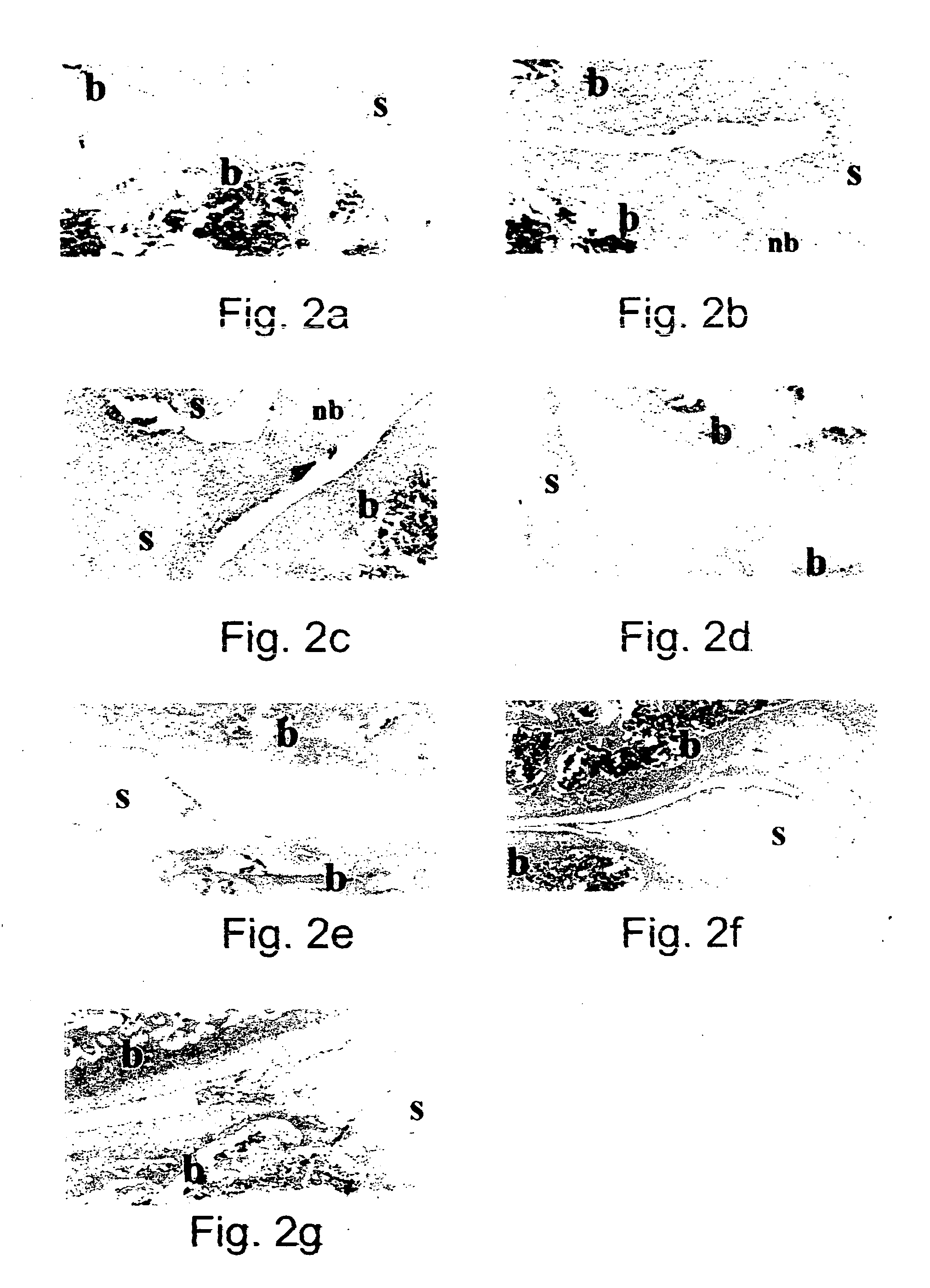 Pharmaceutical compositions and method for treating rheumathoid arthritis