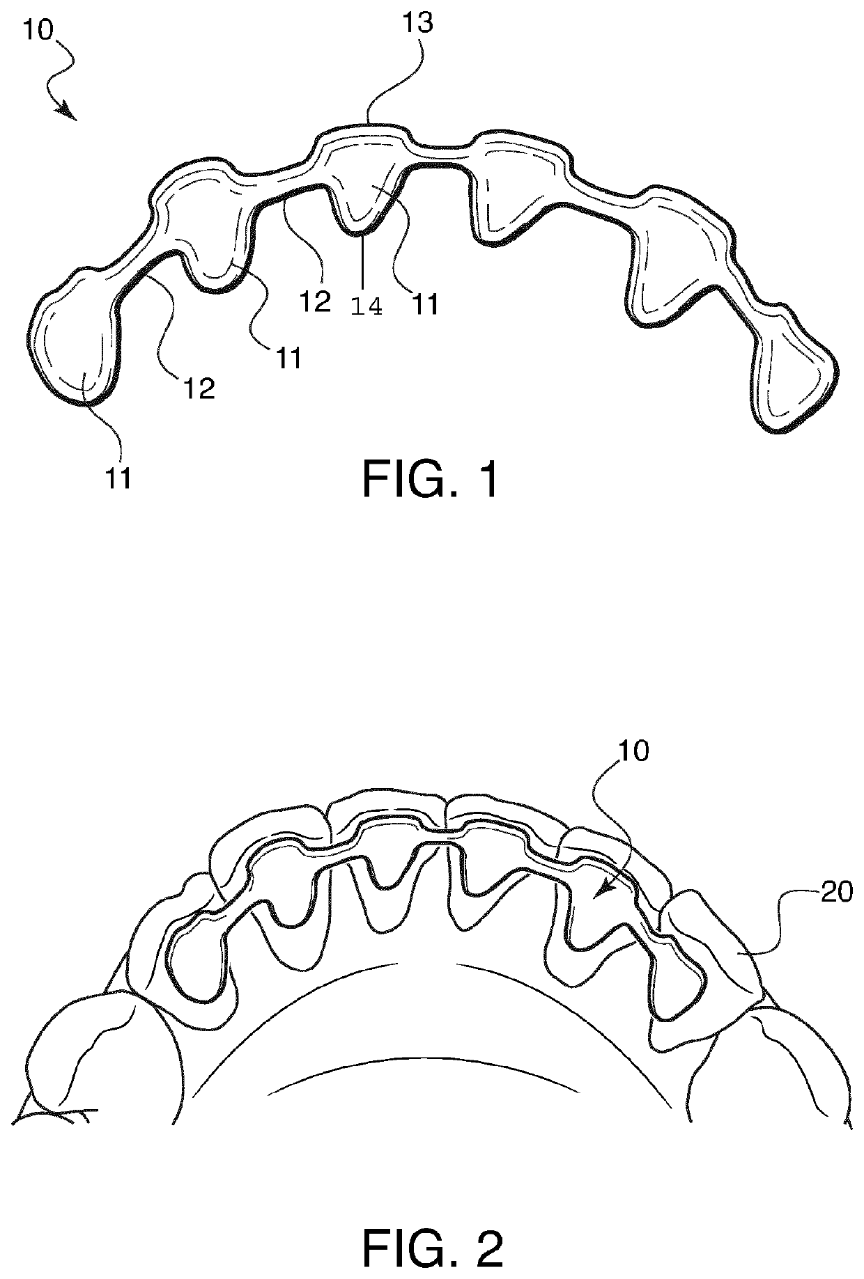 Lingual retainer