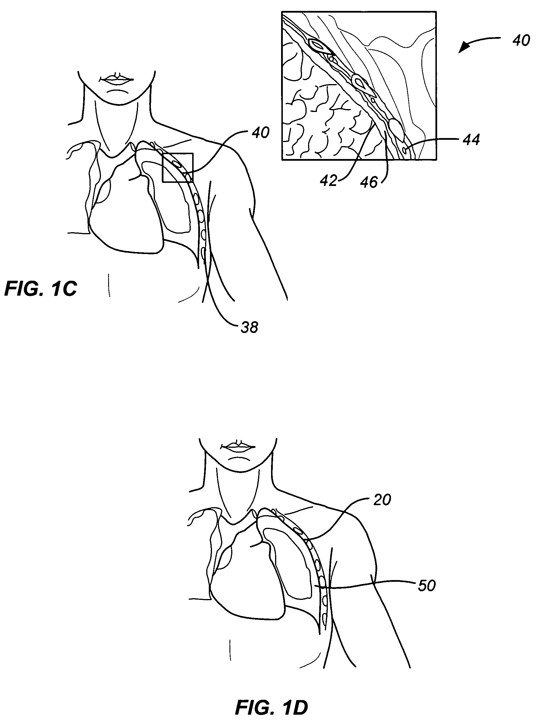 Lung device with sealing features