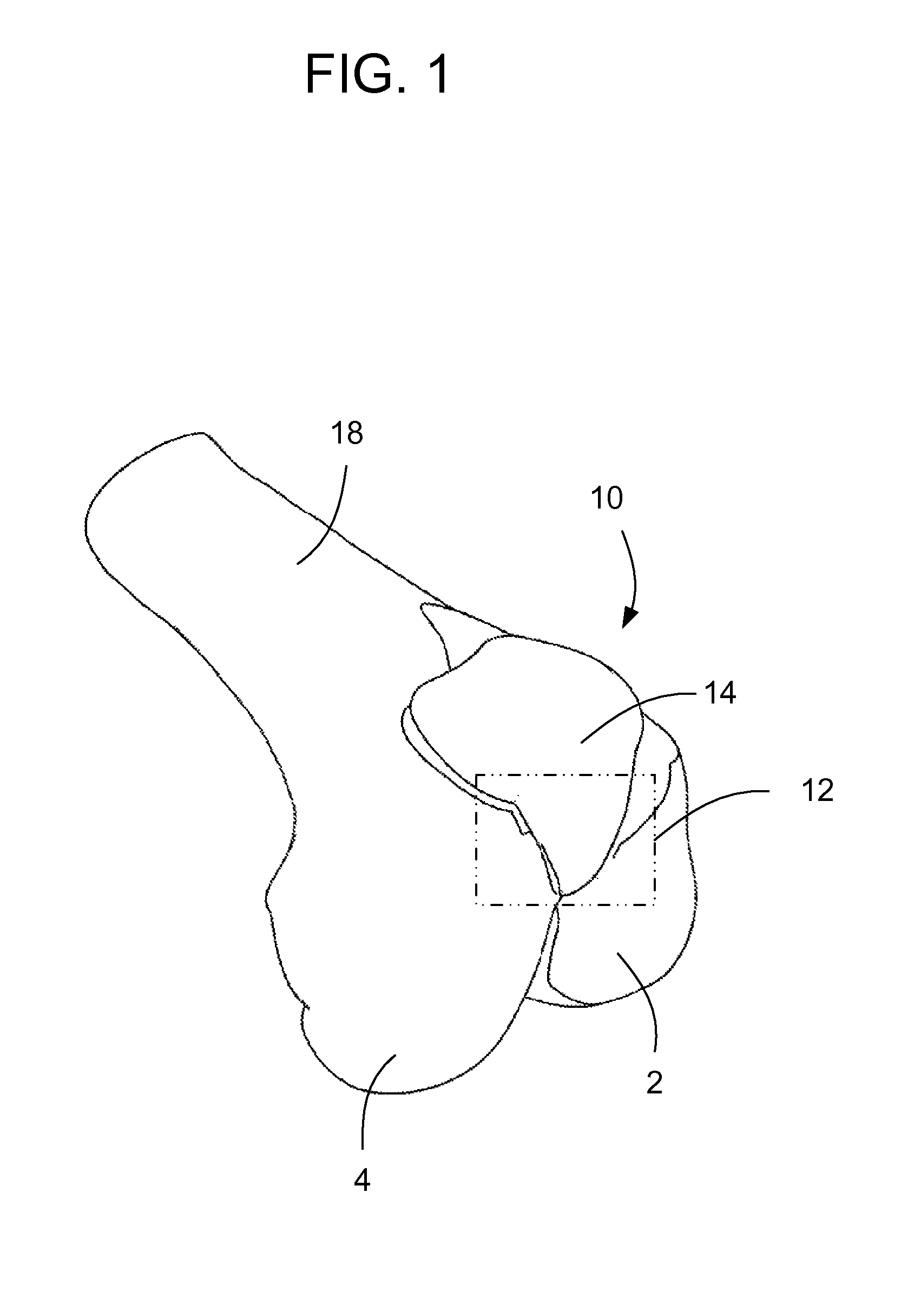 Methods and apparatus for preparing a patient's femur for patellofemoral knee arthroplasty