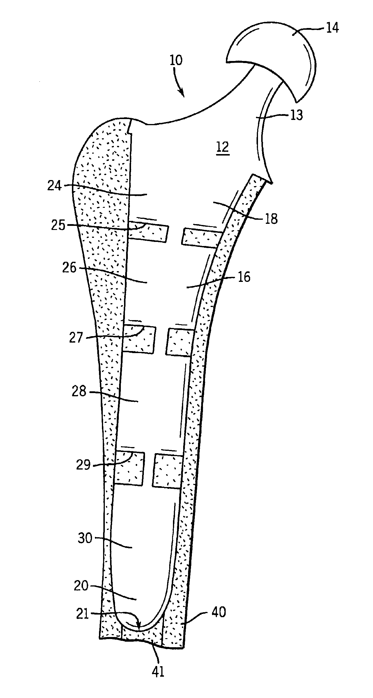 Prosthetic implant having segmented flexible stem