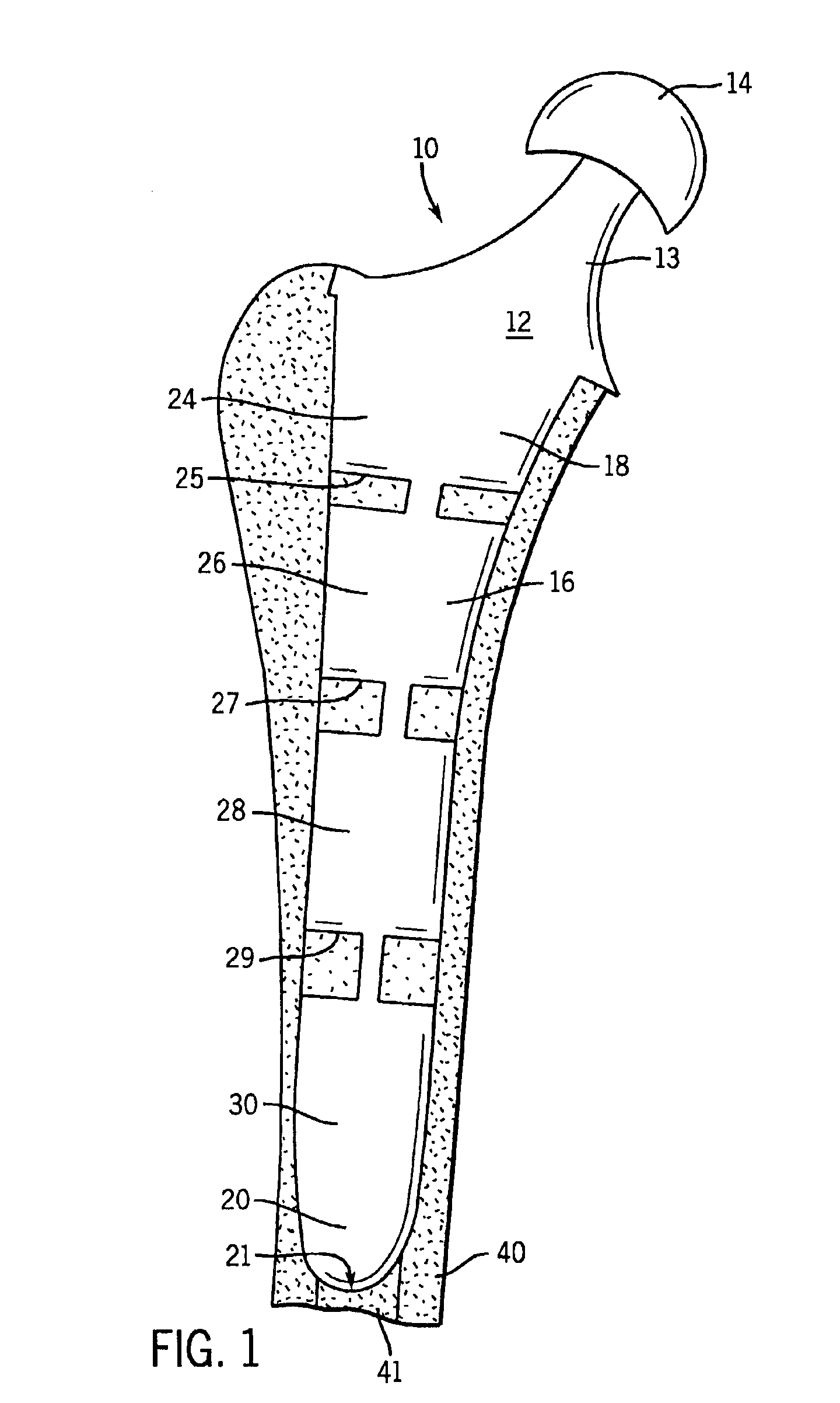 Prosthetic implant having segmented flexible stem