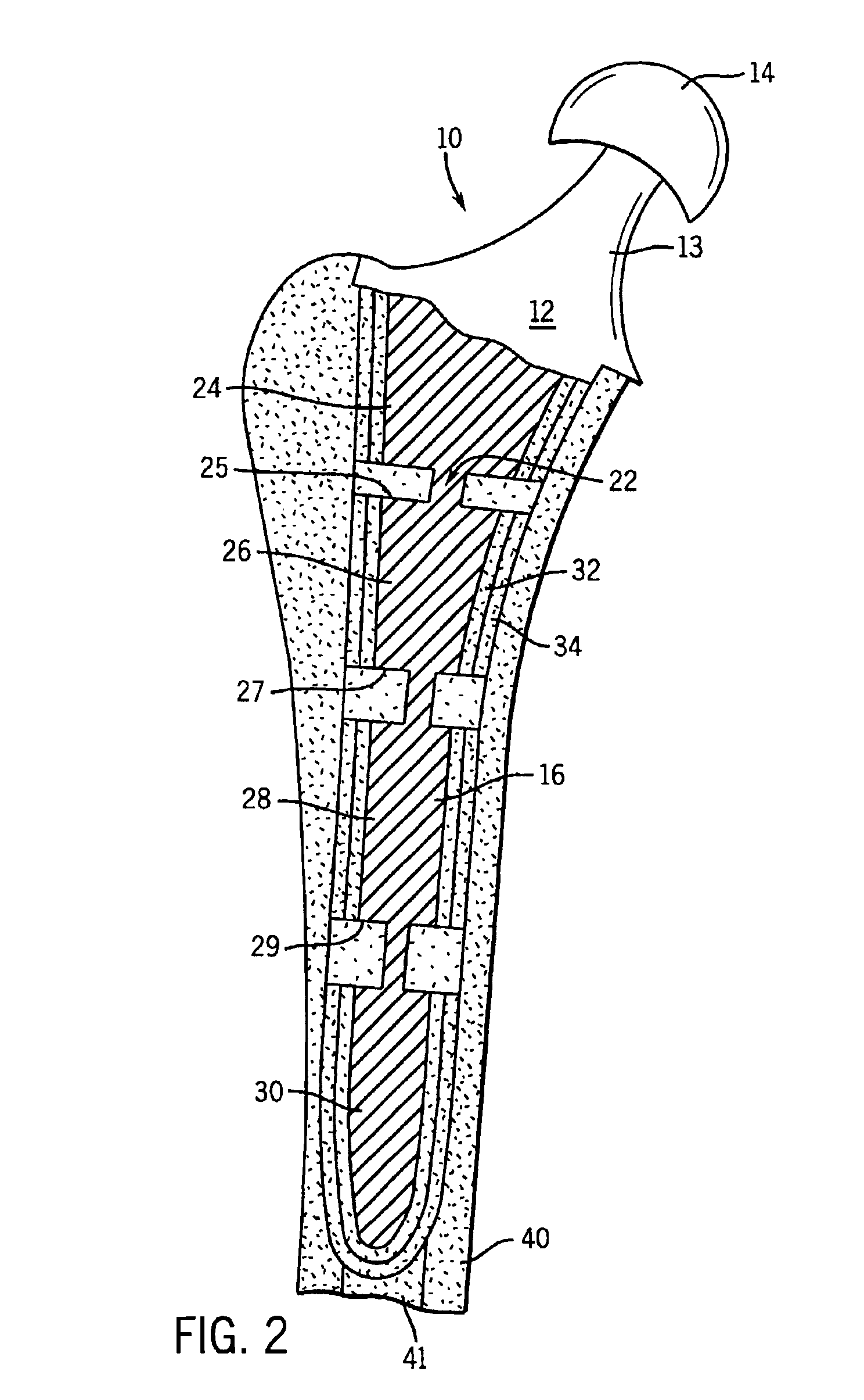 Prosthetic implant having segmented flexible stem