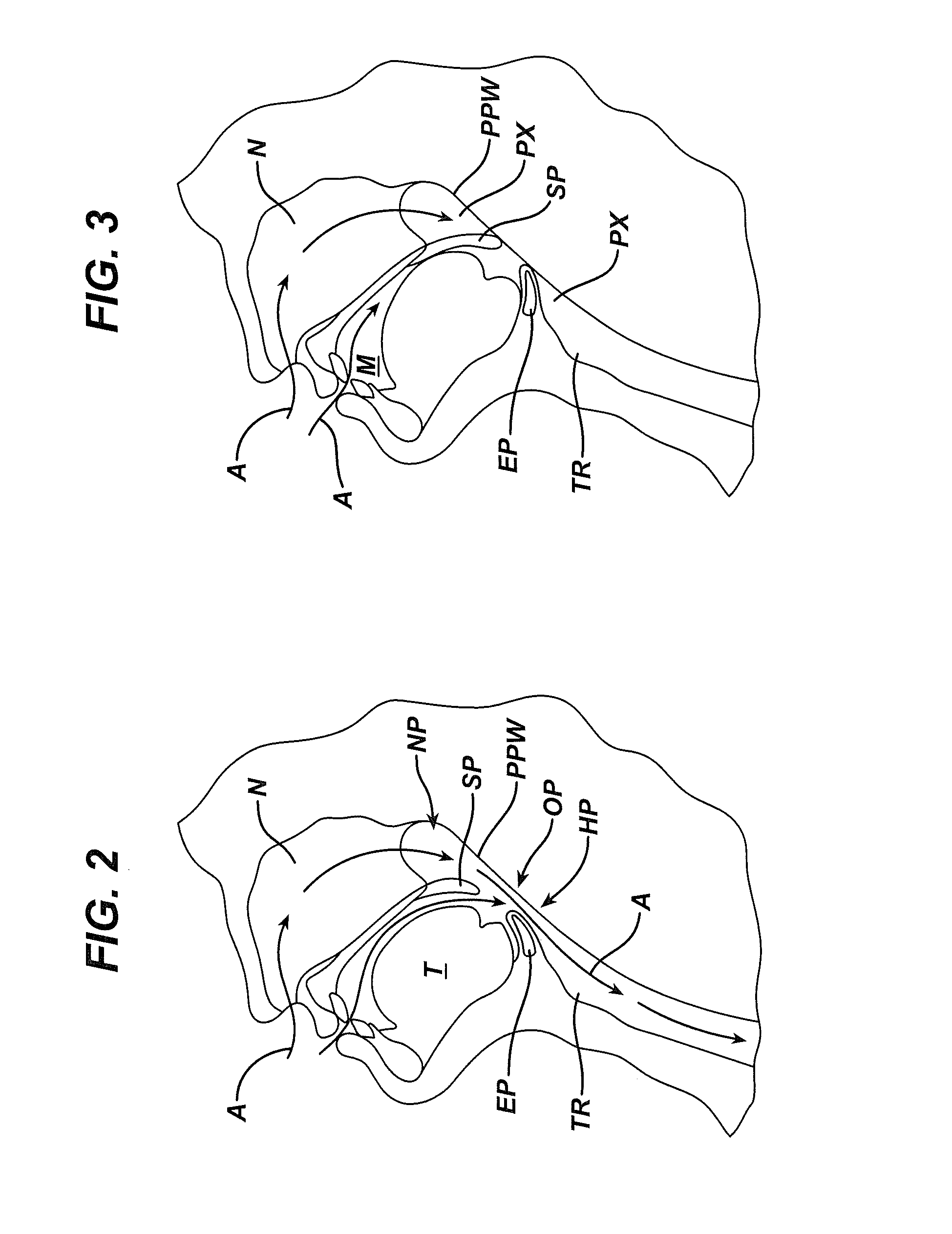 Tongue suspension device and method