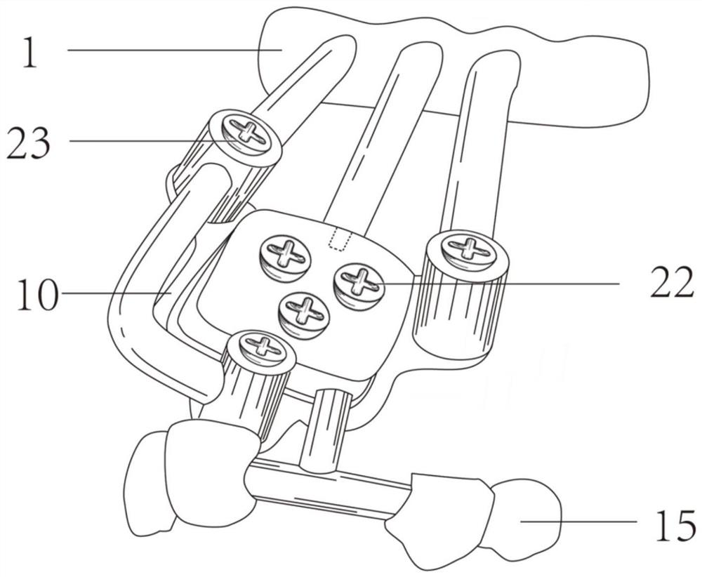 Intraoral combined tooth positioning blocky bone extraction and transplantation whole-course guide plate and manufacturing method thereof