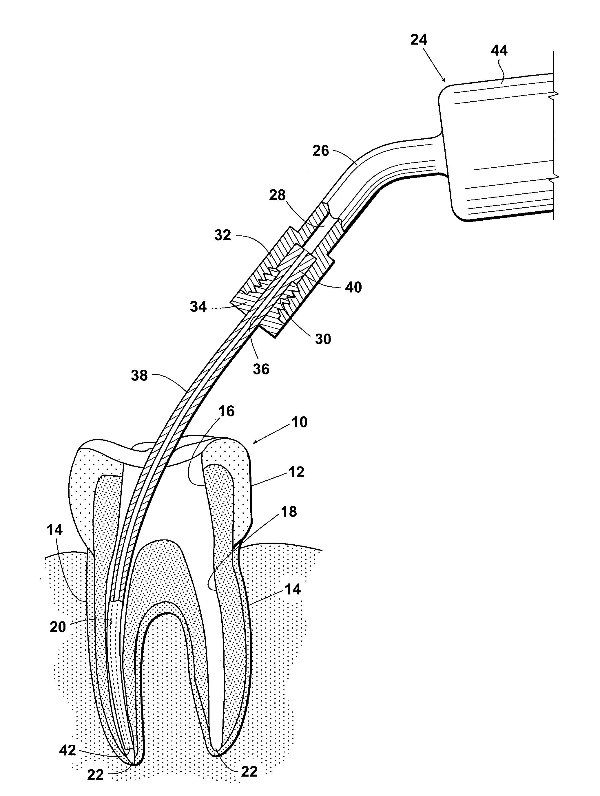 Endodontic procedure employing simultaneous liquefaction and acoustic debridgement