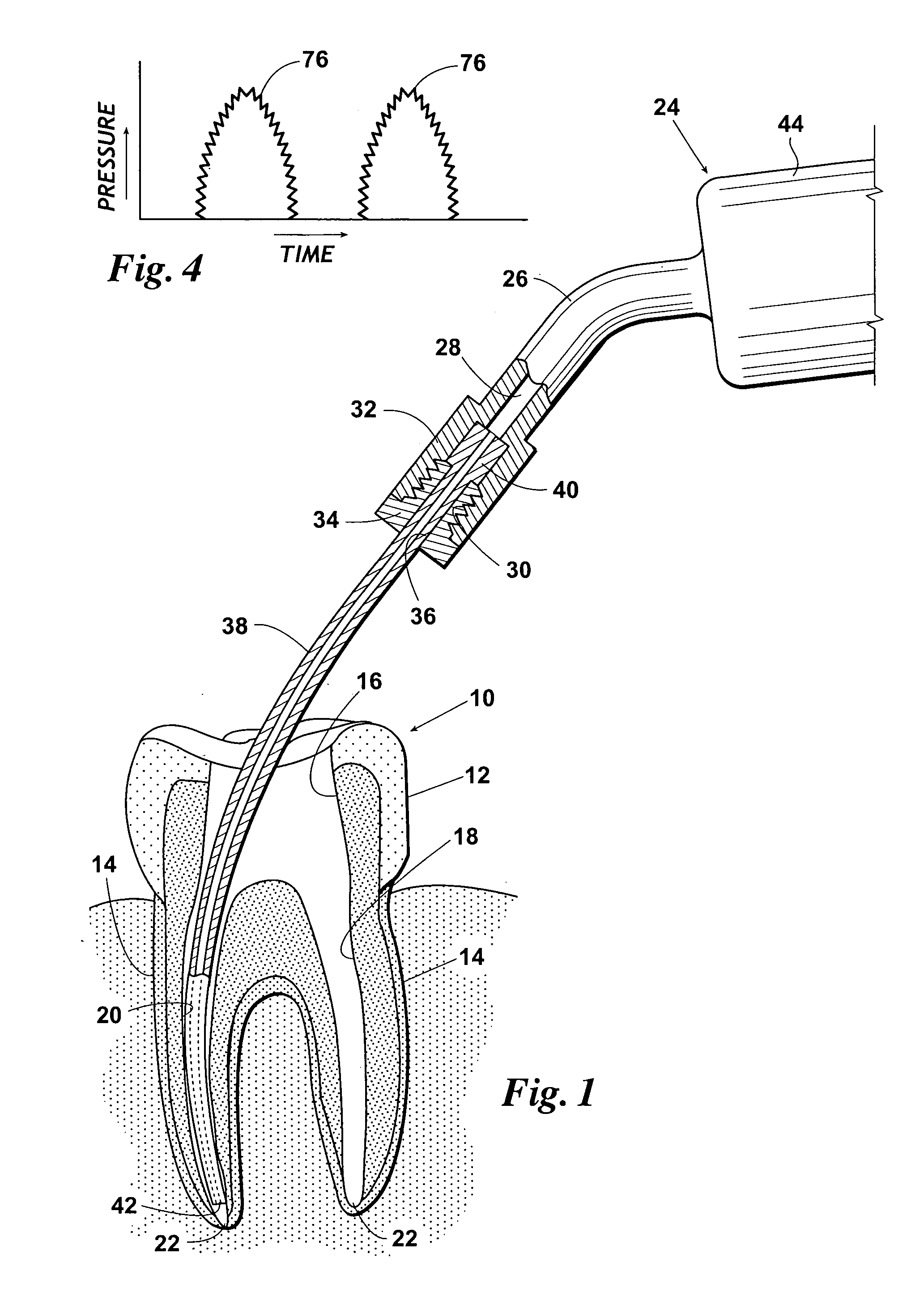 Endodontic procedure employing simultaneous liquefaction and acoustic debridgement