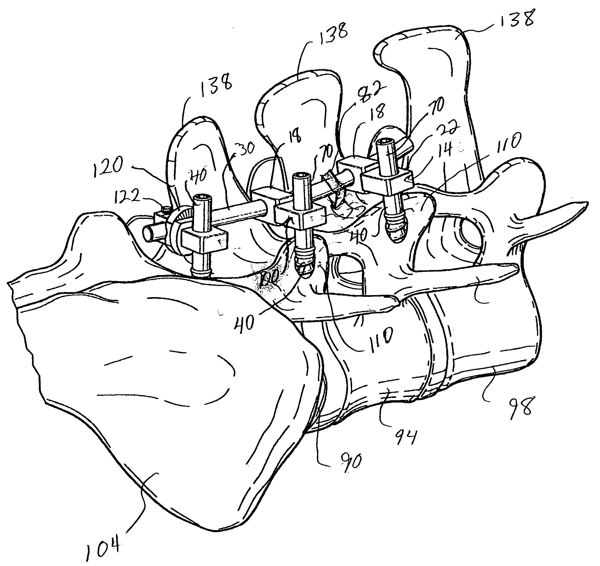 Artificial facet joint and method