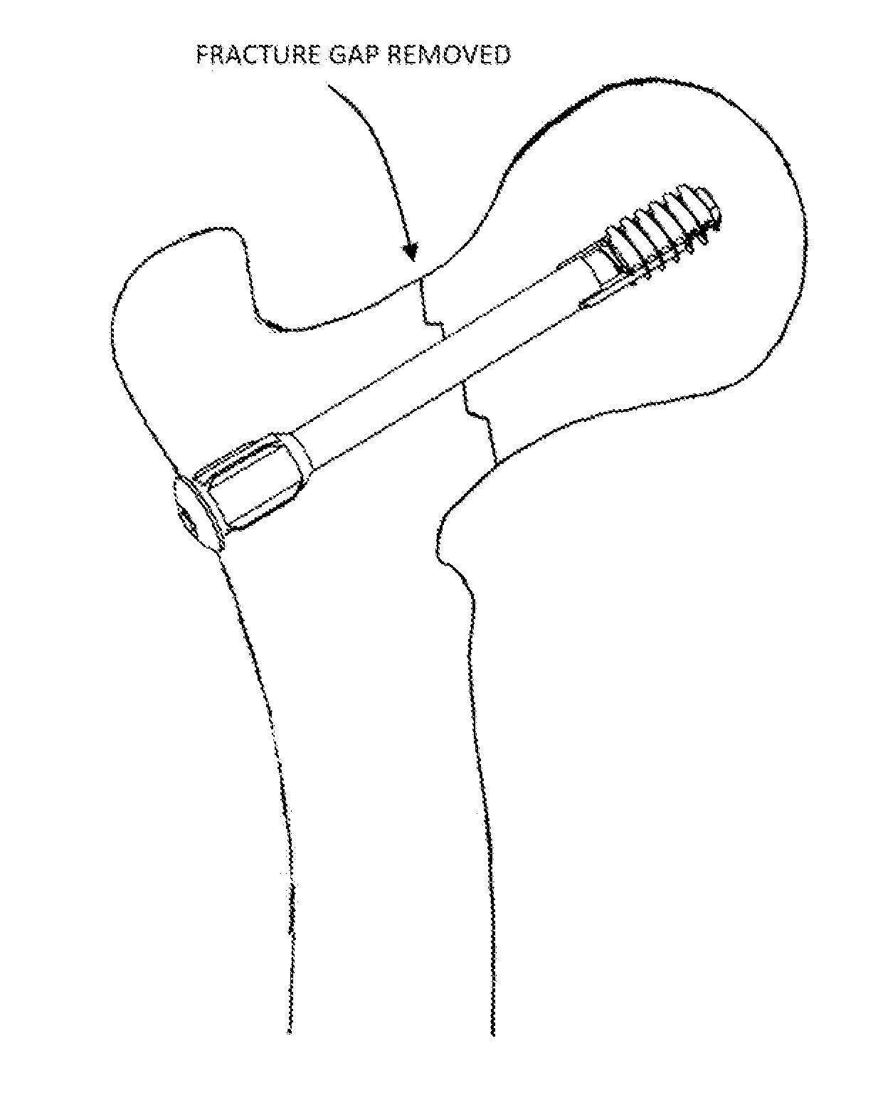 Bone fixation screw and method