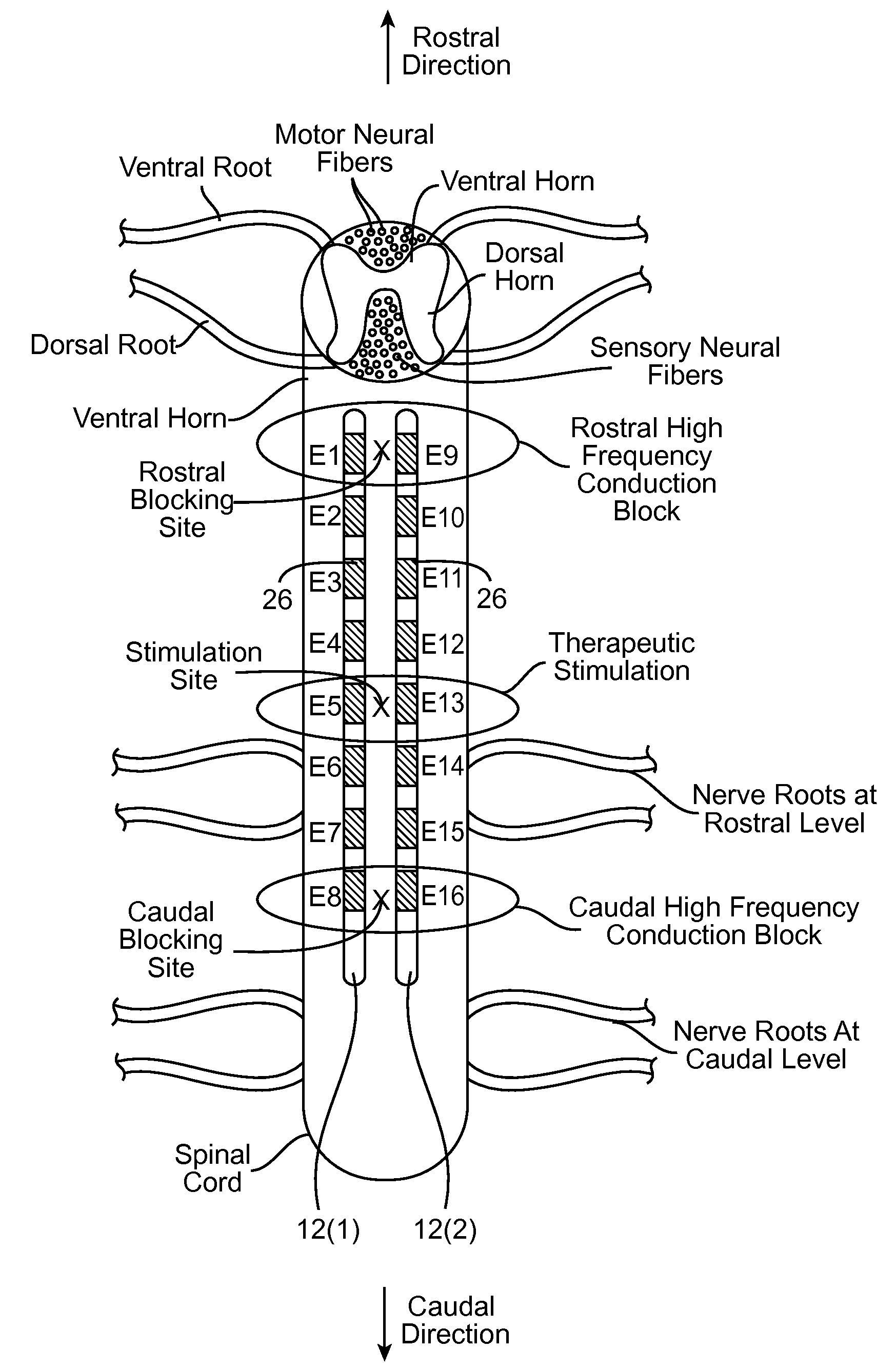 Neurostimulation system and method for providing therapy to patient with minimal side effects