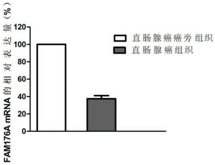 Applications of FAM176A gene in diagnosis and treatment for rectum adenocarcinoma