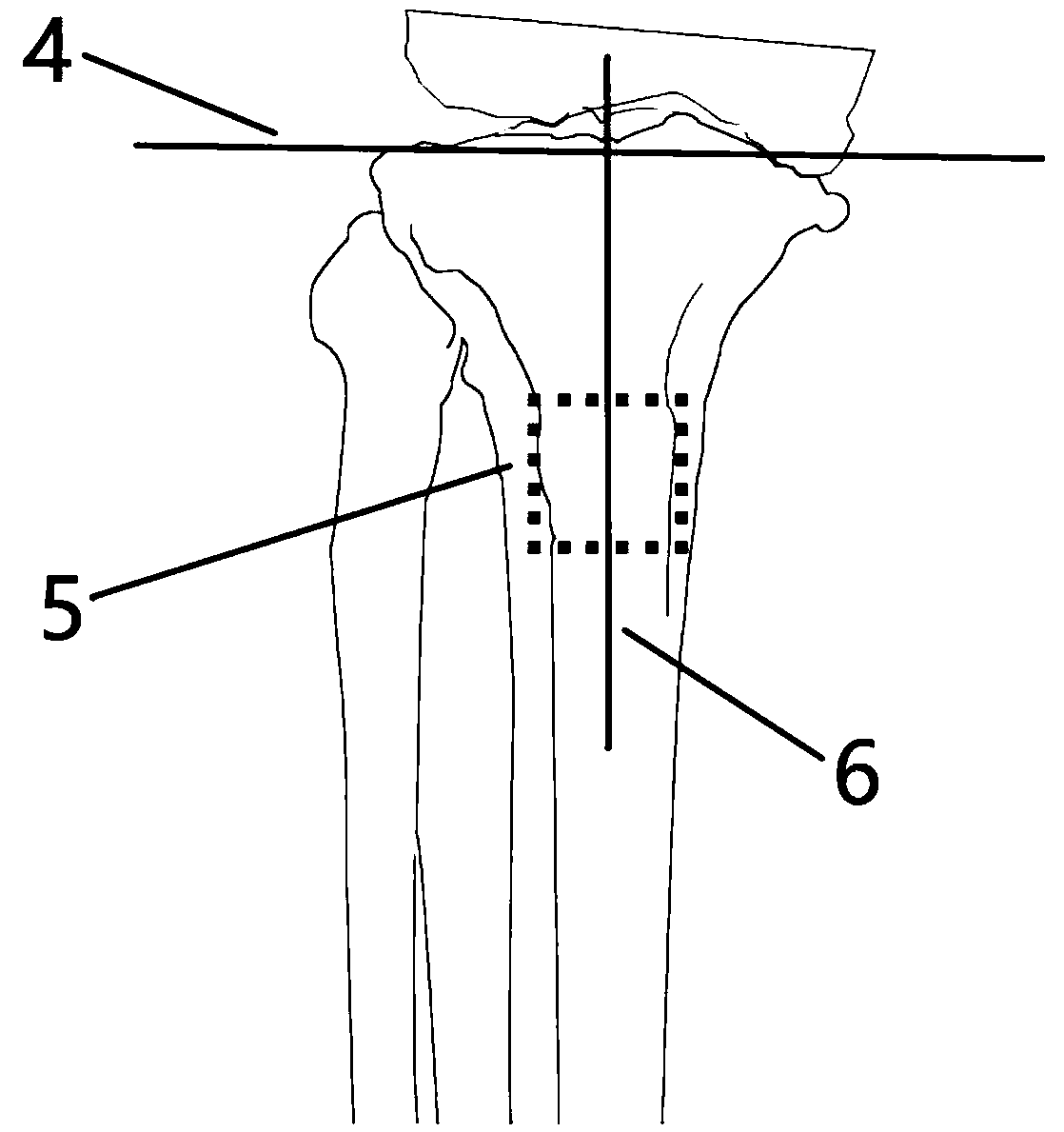 Construction method of high tibial osteotomy guide plate model