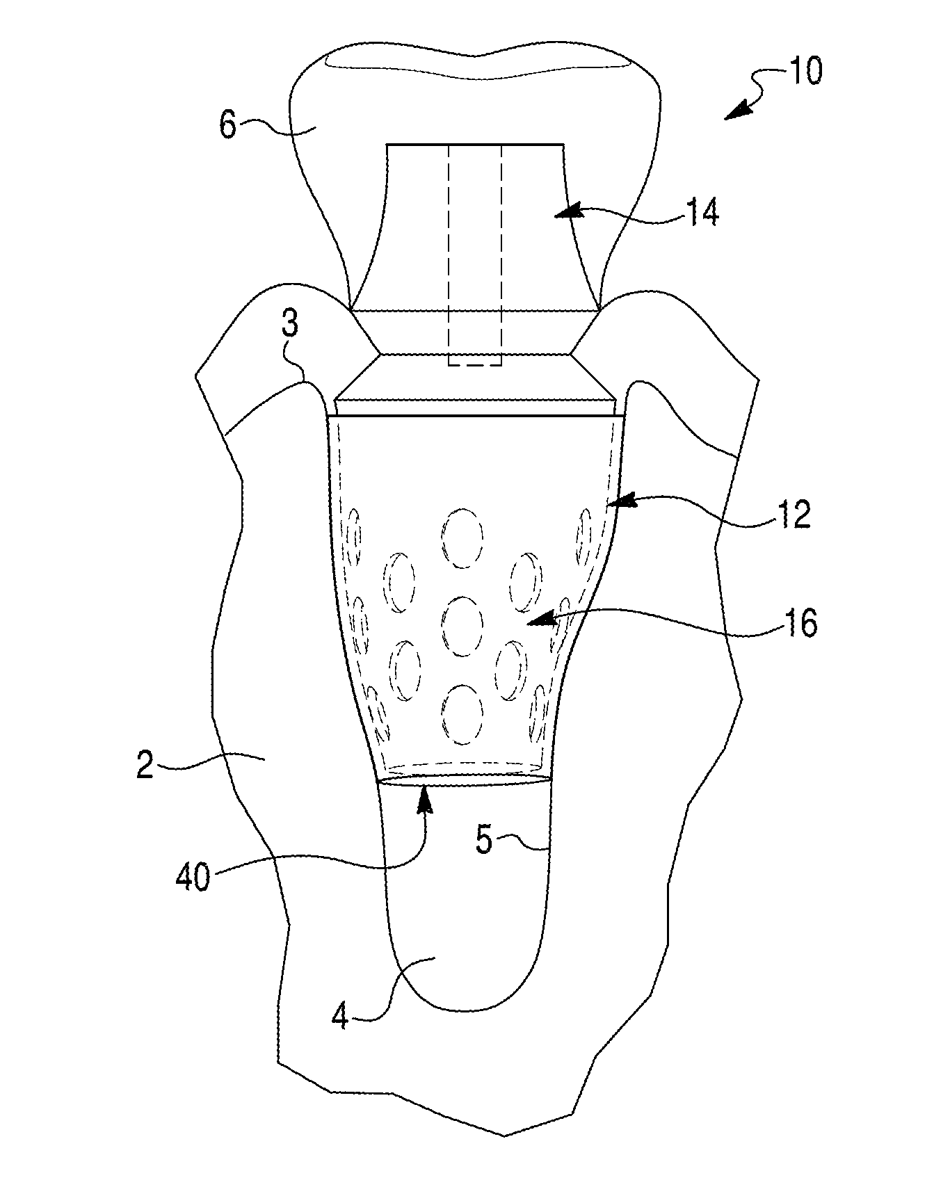 Endosseous dental implant assembly