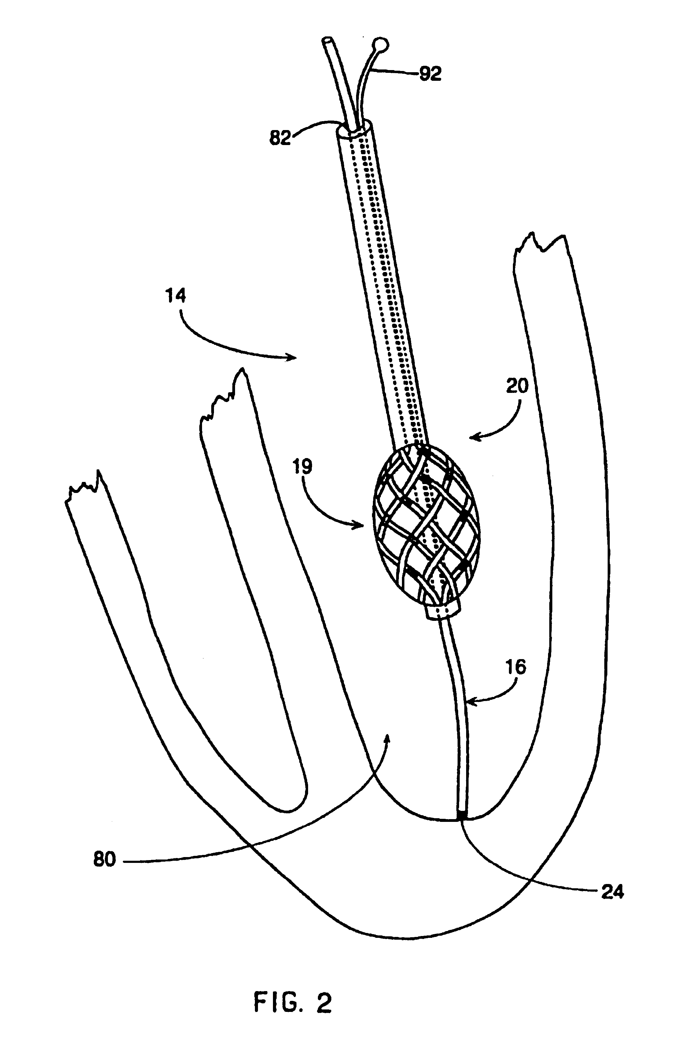 Endocardial mapping system