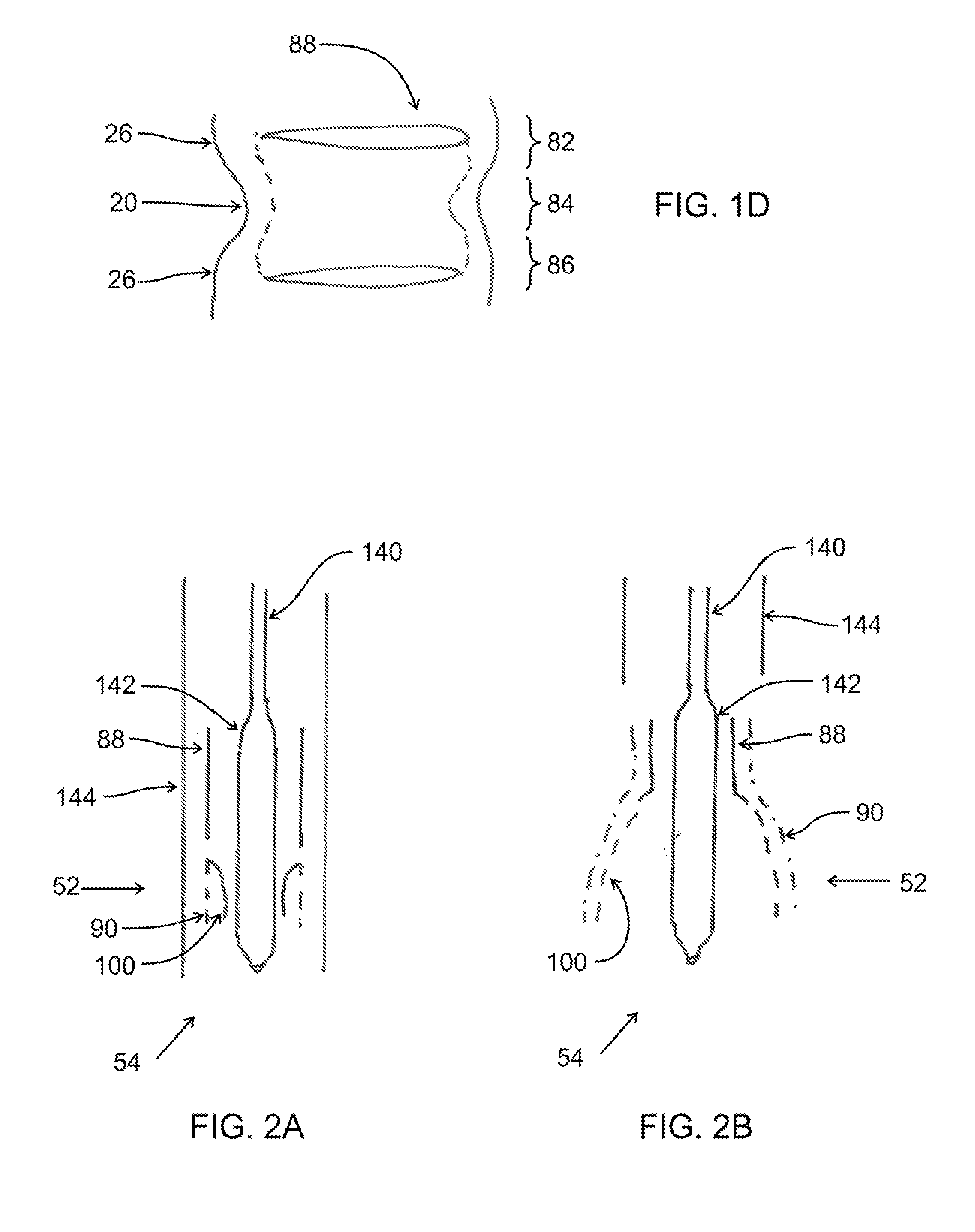 Transcatheter Mitral Valve Replacement Apparatus