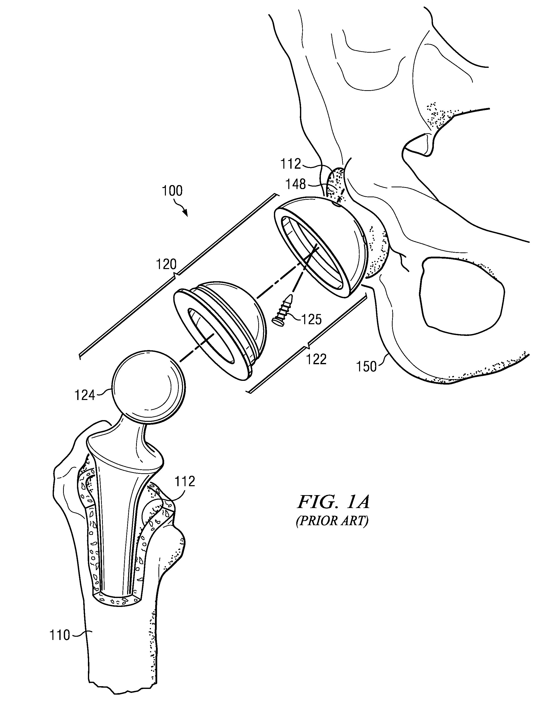 Electrosurgical system and method for treating hard body tissue