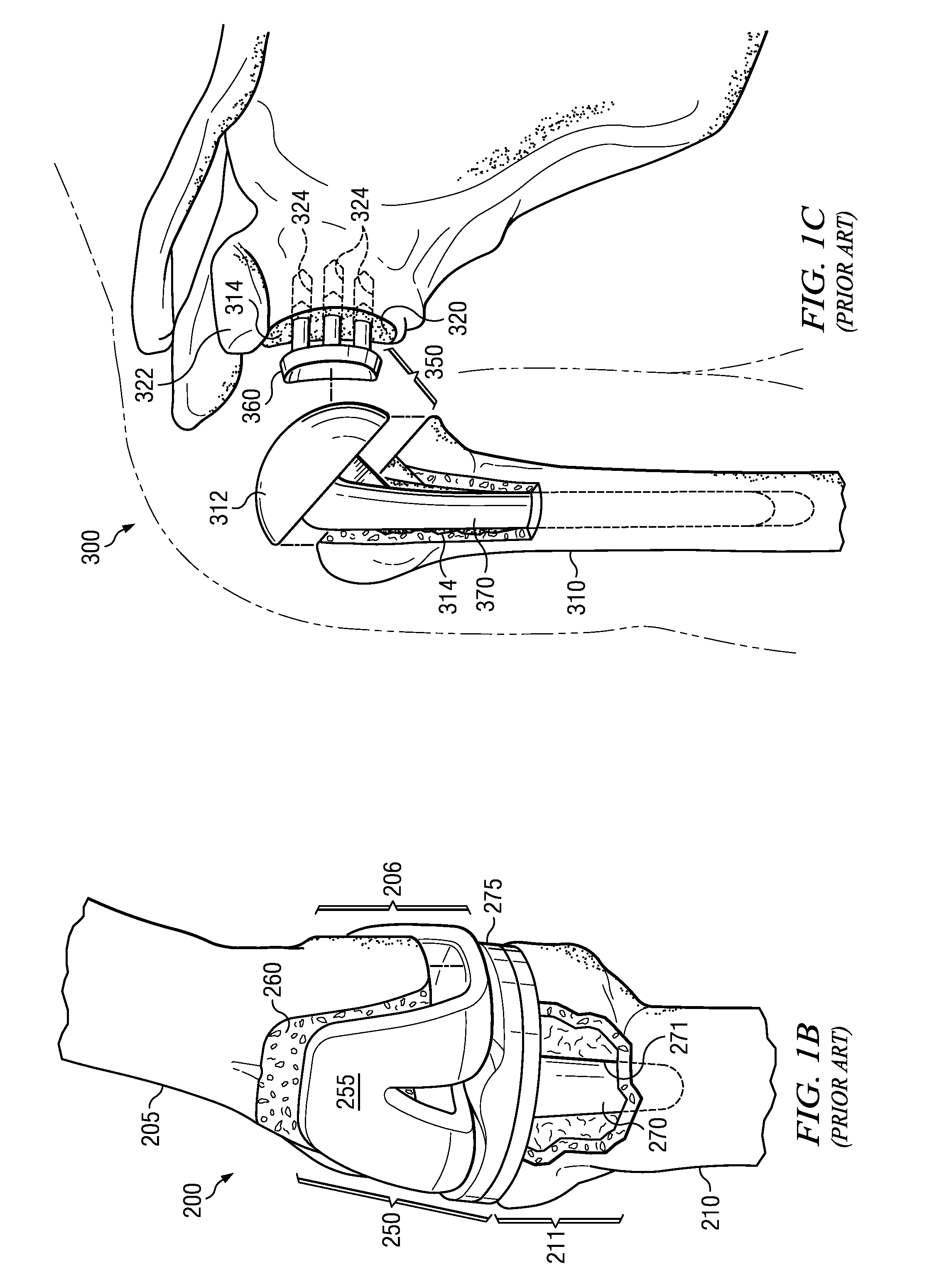 Electrosurgical system and method for treating hard body tissue