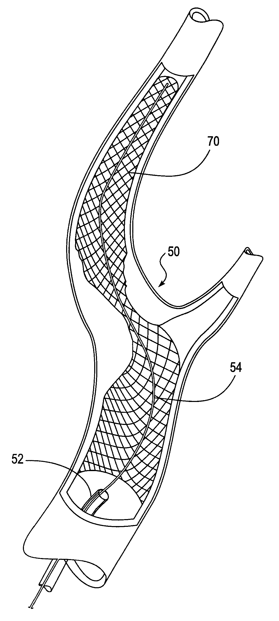 Catheter system for angioplasty and stenting with embolic protection