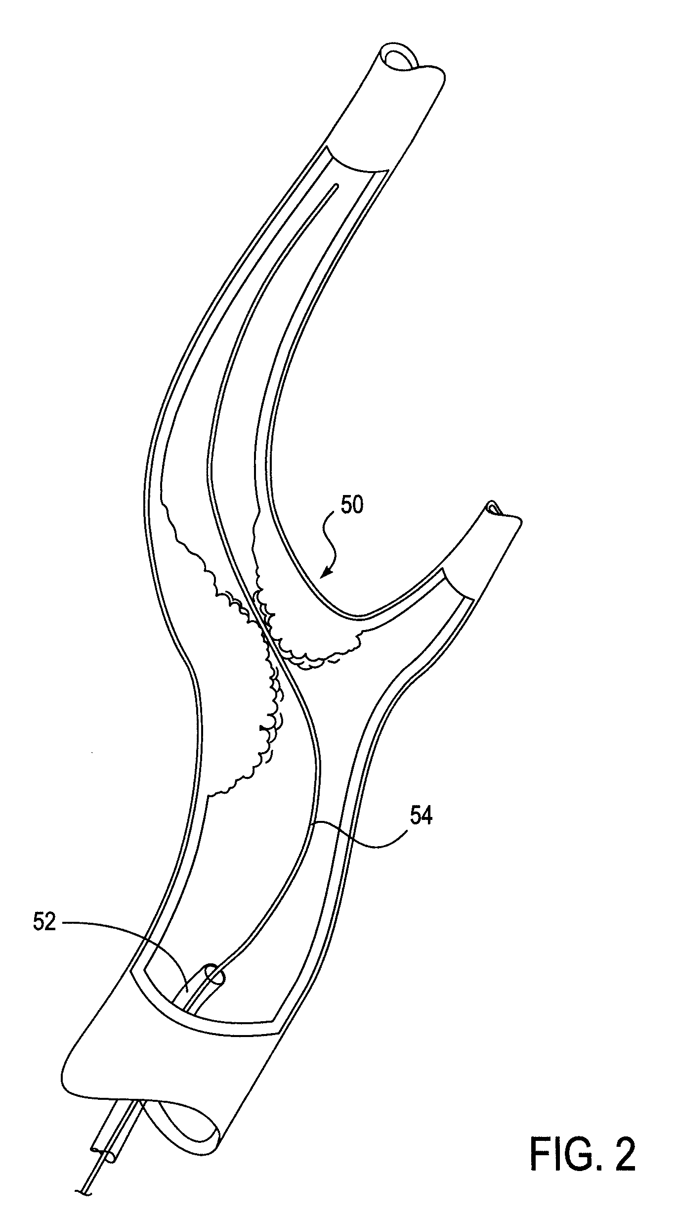 Catheter system for angioplasty and stenting with embolic protection