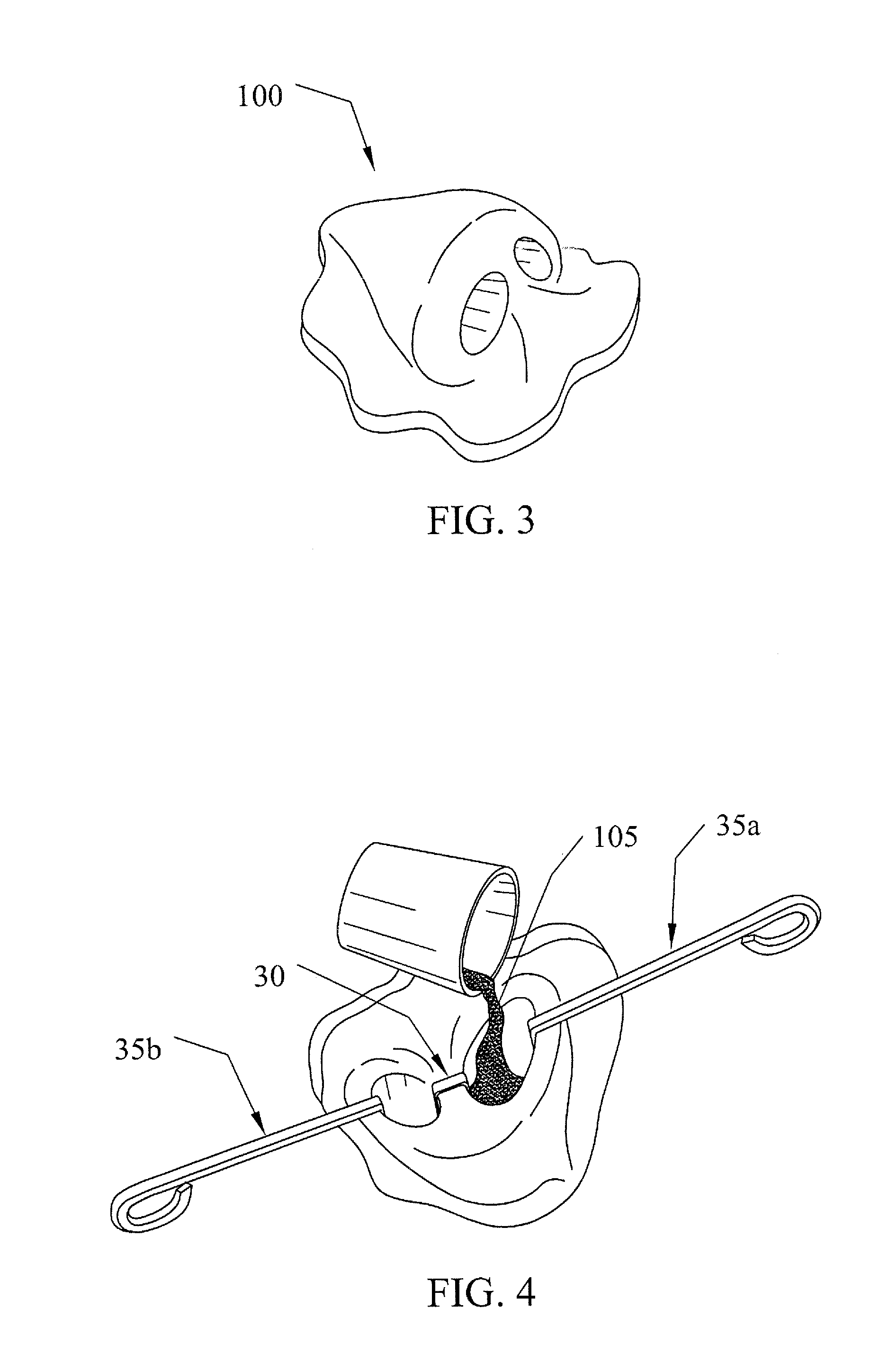 Rhinoplasty appliance and method of forming the same