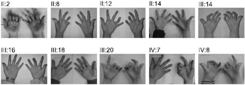 The causative gene of distal arthrogryposis and its application