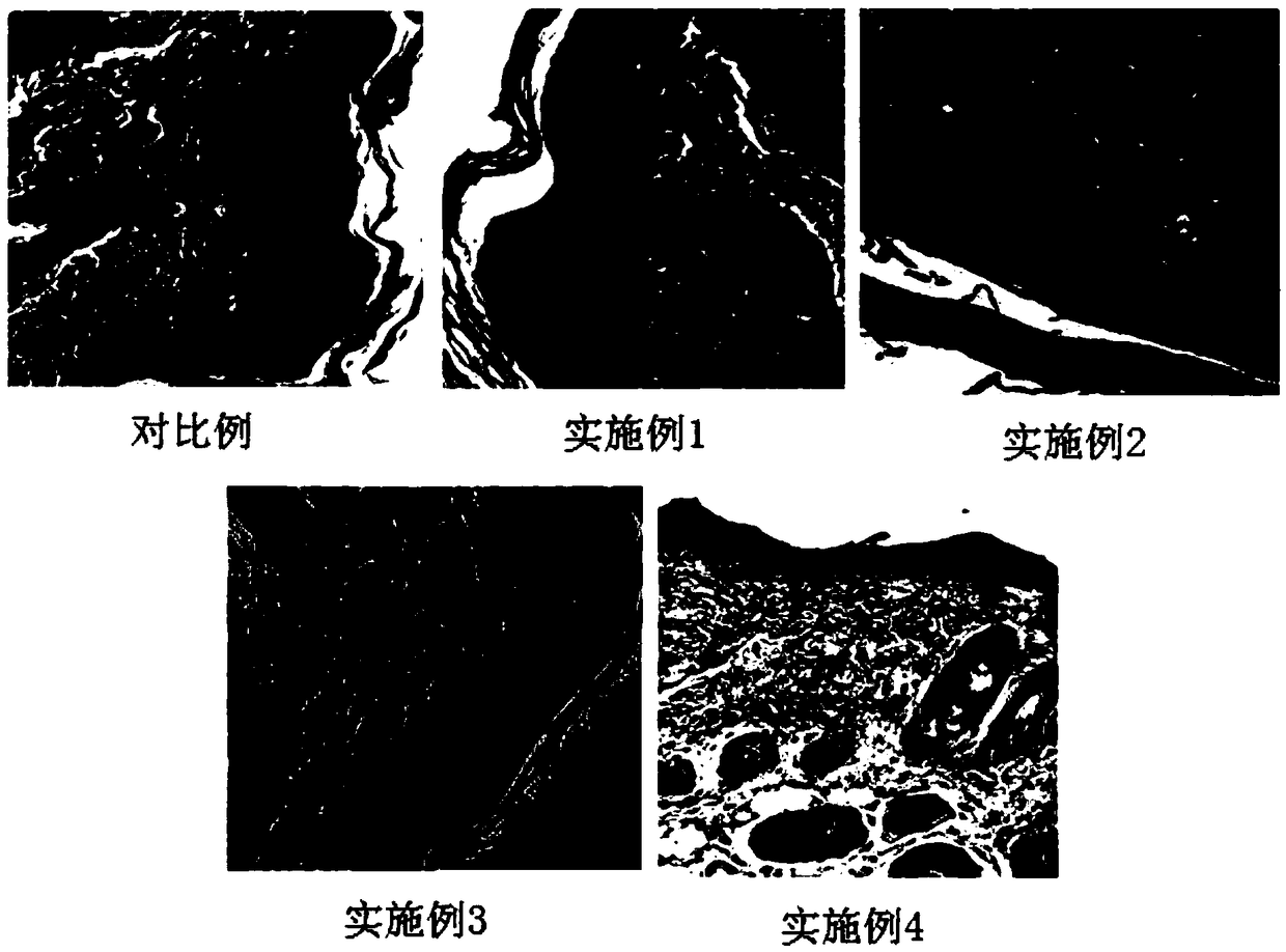 Dressing used for alleviating psoriasis, and preparation method thereof