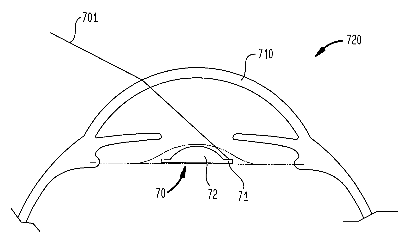 Ocular implant to correct dysphotopsia, glare, halos and dark shadow type phenomena