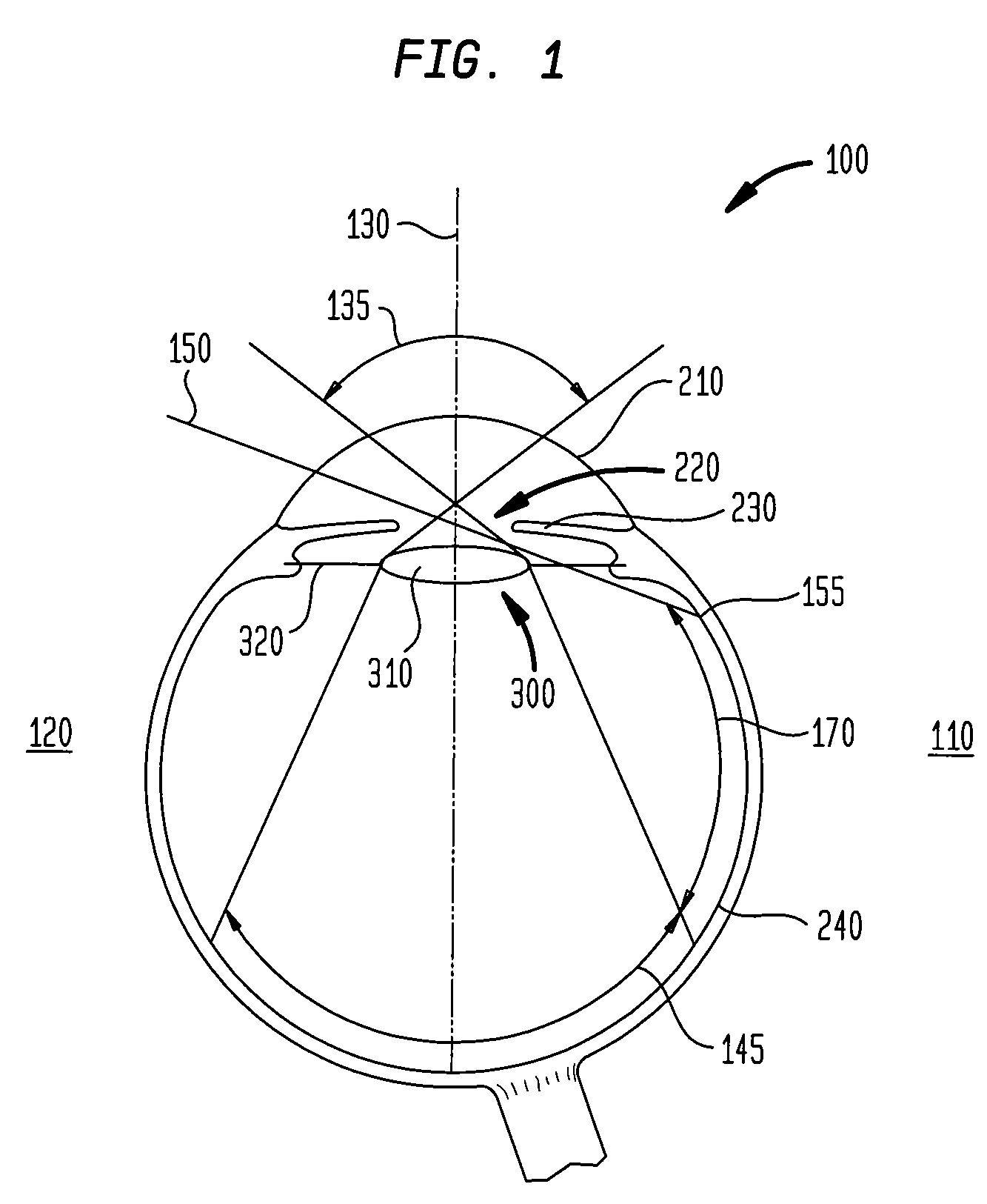 Ocular implant to correct dysphotopsia, glare, halos and dark shadow type phenomena