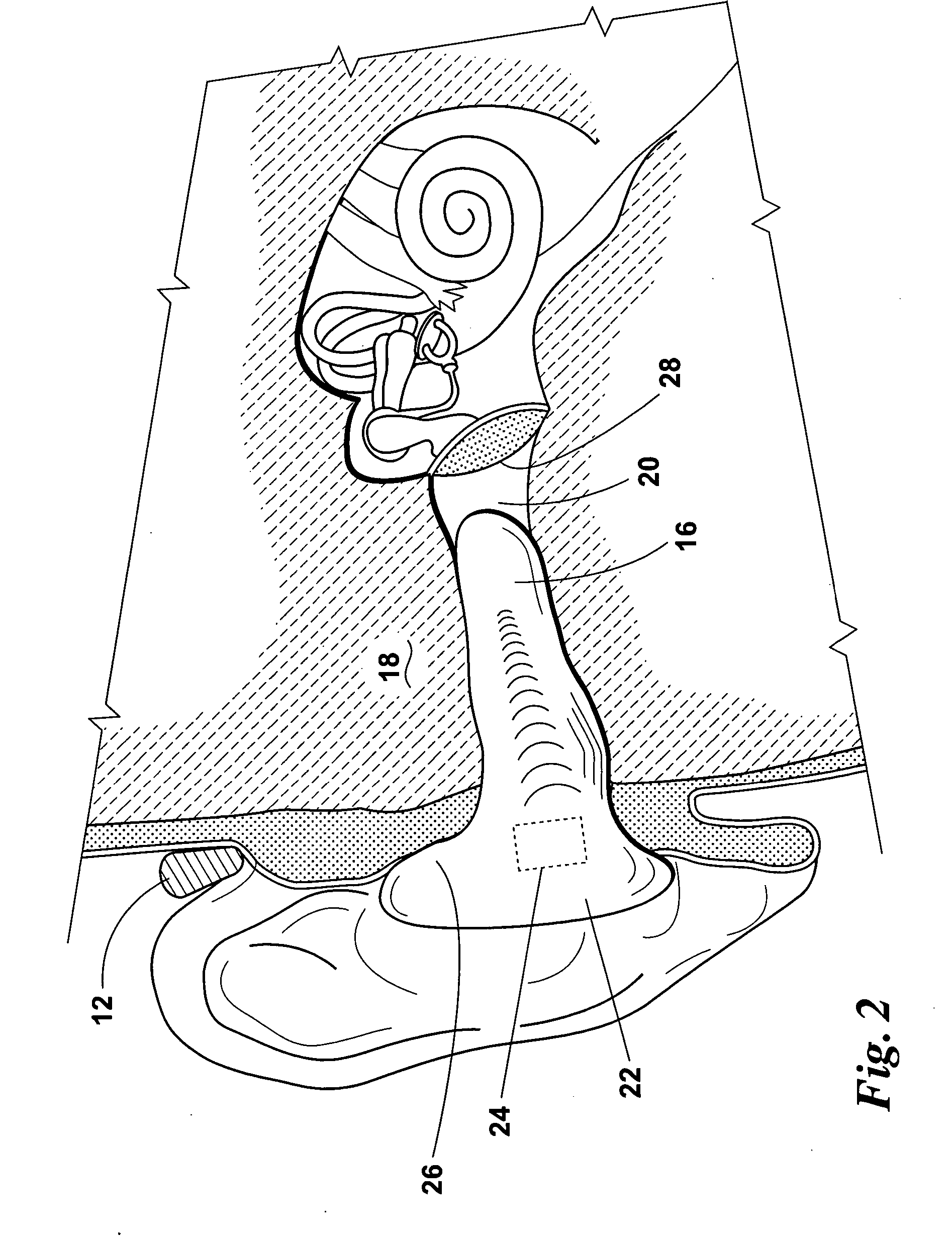 Bone conduction hearing assistance device