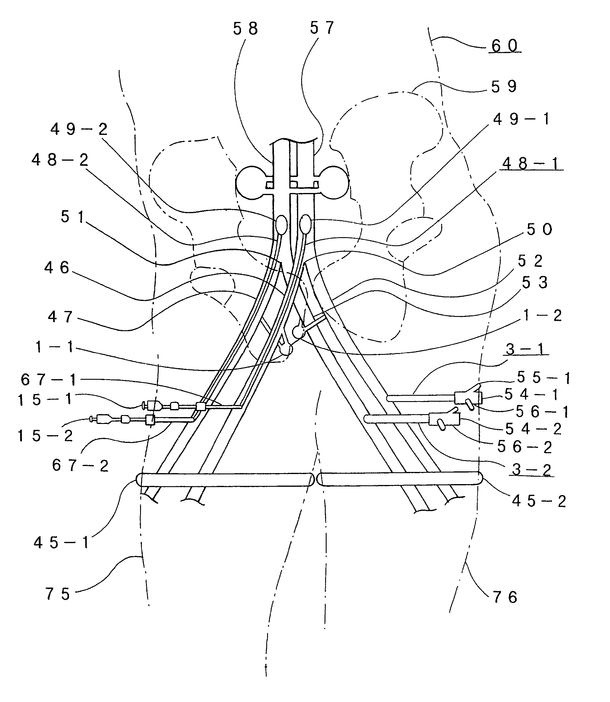 Intrapelvic perfusion therapy with cancer therapeutic agent and apparatus for intrapelvic perfusion with cancer therapeutic agent