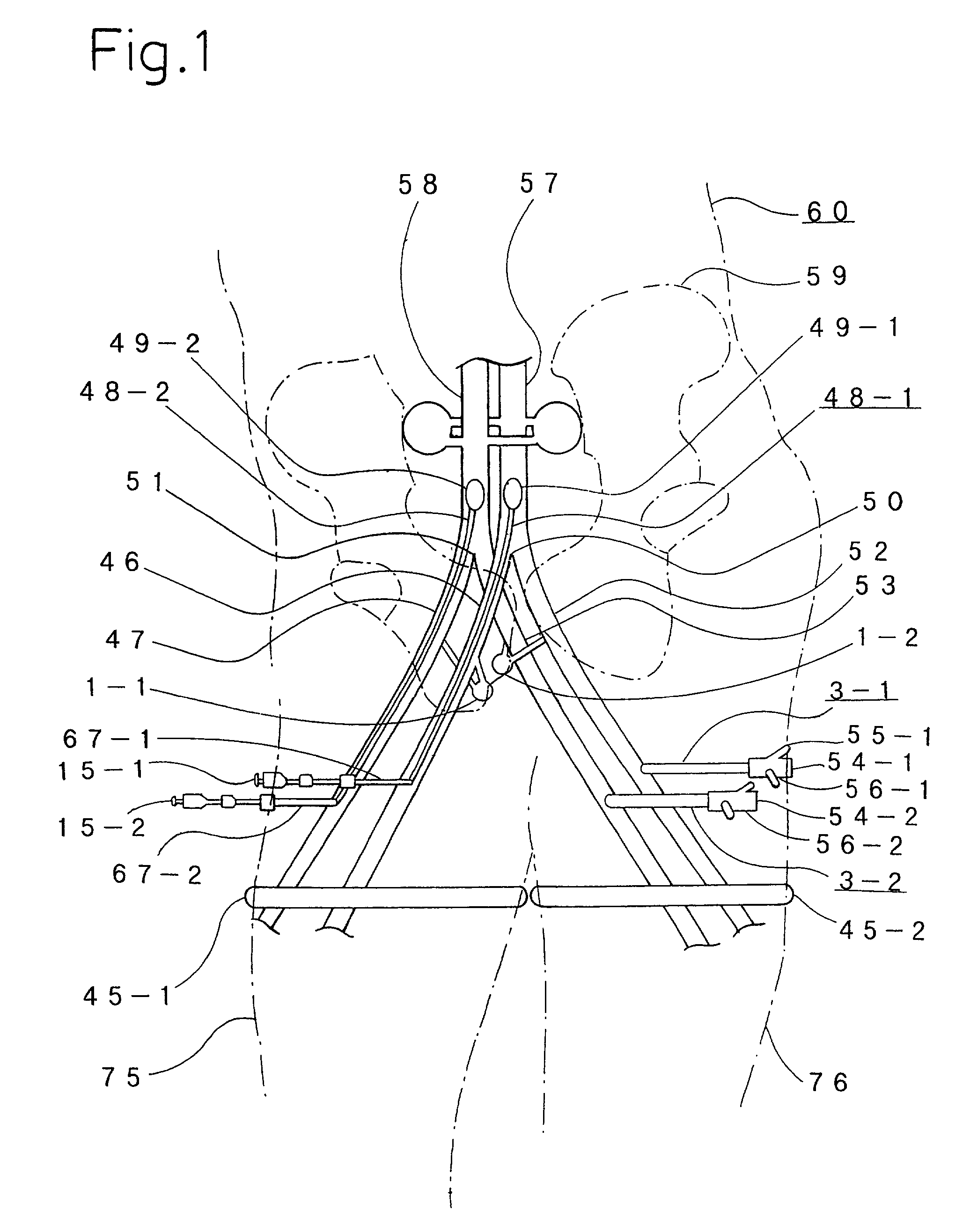 Intrapelvic perfusion therapy with cancer therapeutic agent and apparatus for intrapelvic perfusion with cancer therapeutic agent