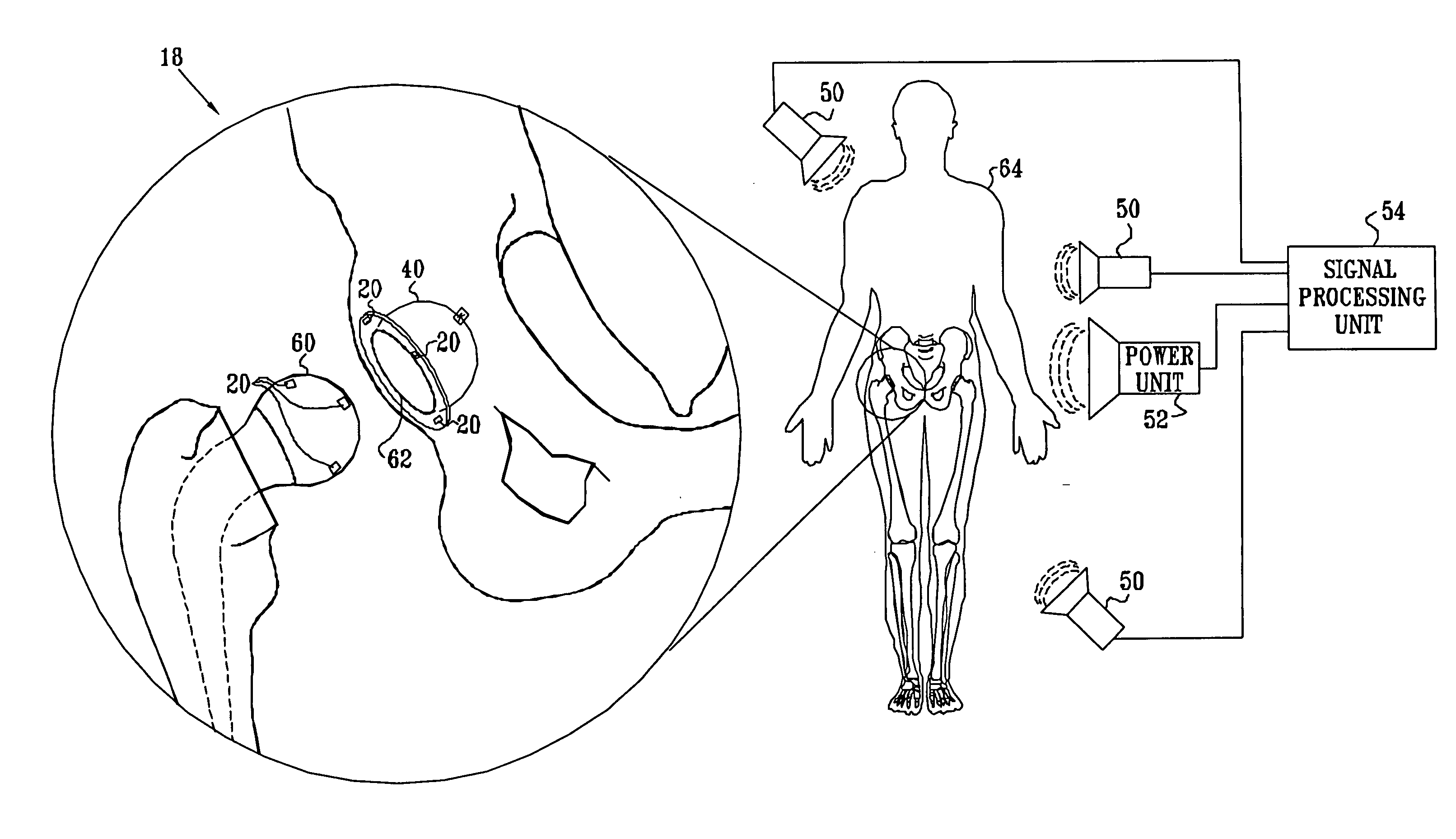 Energy transfer amplification for intrabody devices