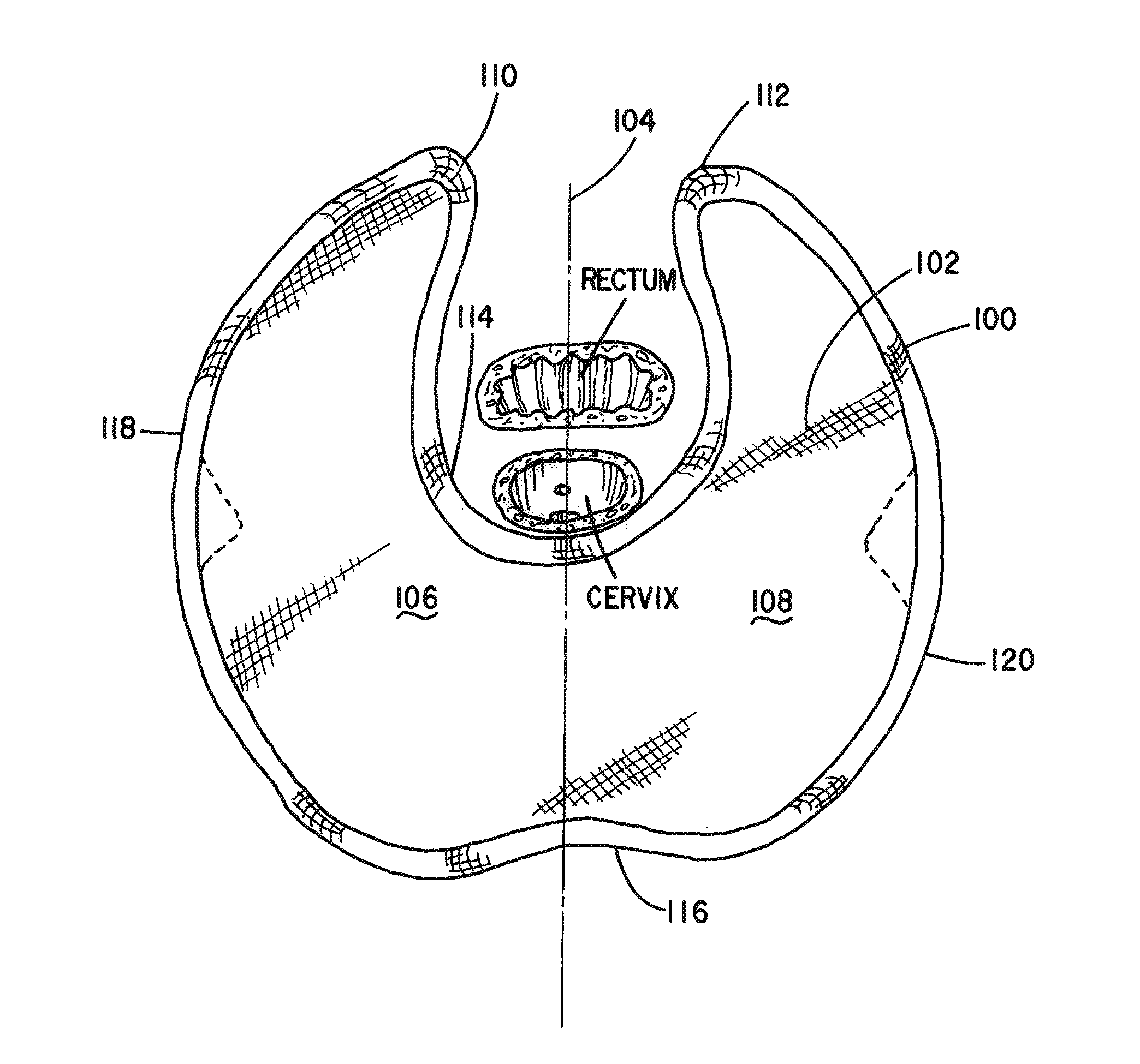 Apparatus and Method for Pelvic Floor Repair in the Human Female