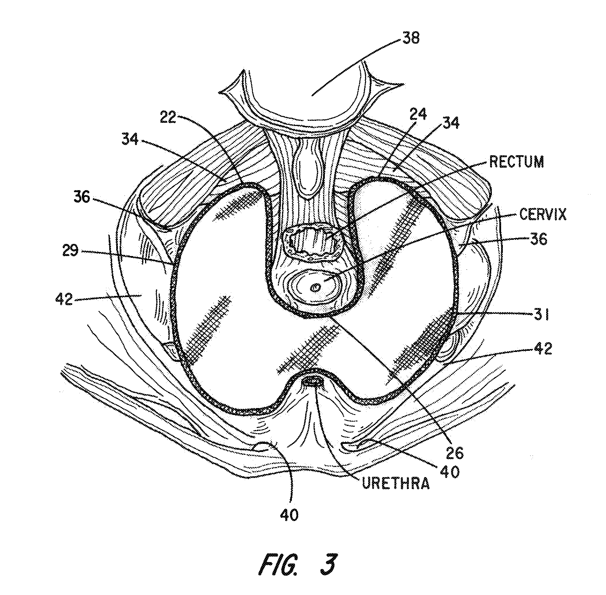 Apparatus and Method for Pelvic Floor Repair in the Human Female