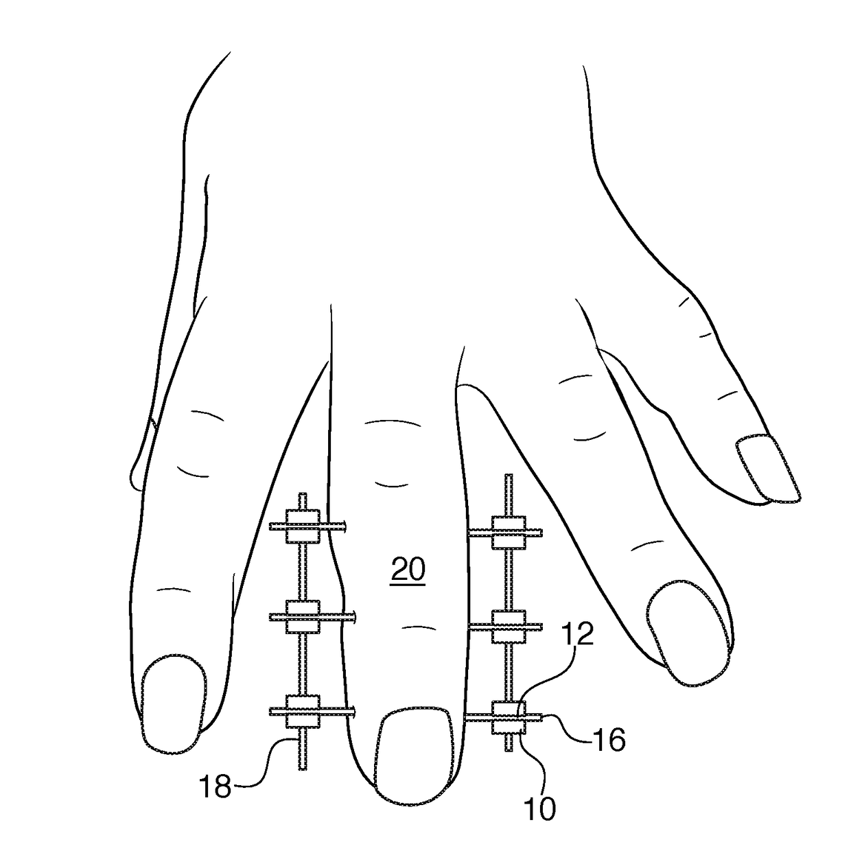 Bracket for external fixation of bones