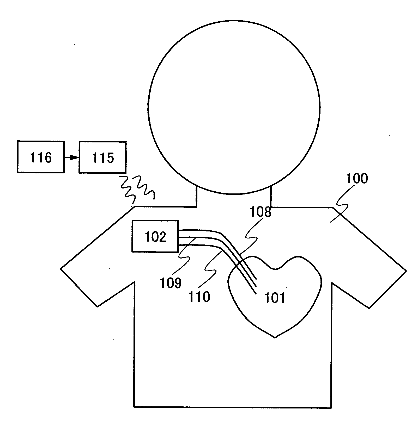 Cardiac pacemaker device