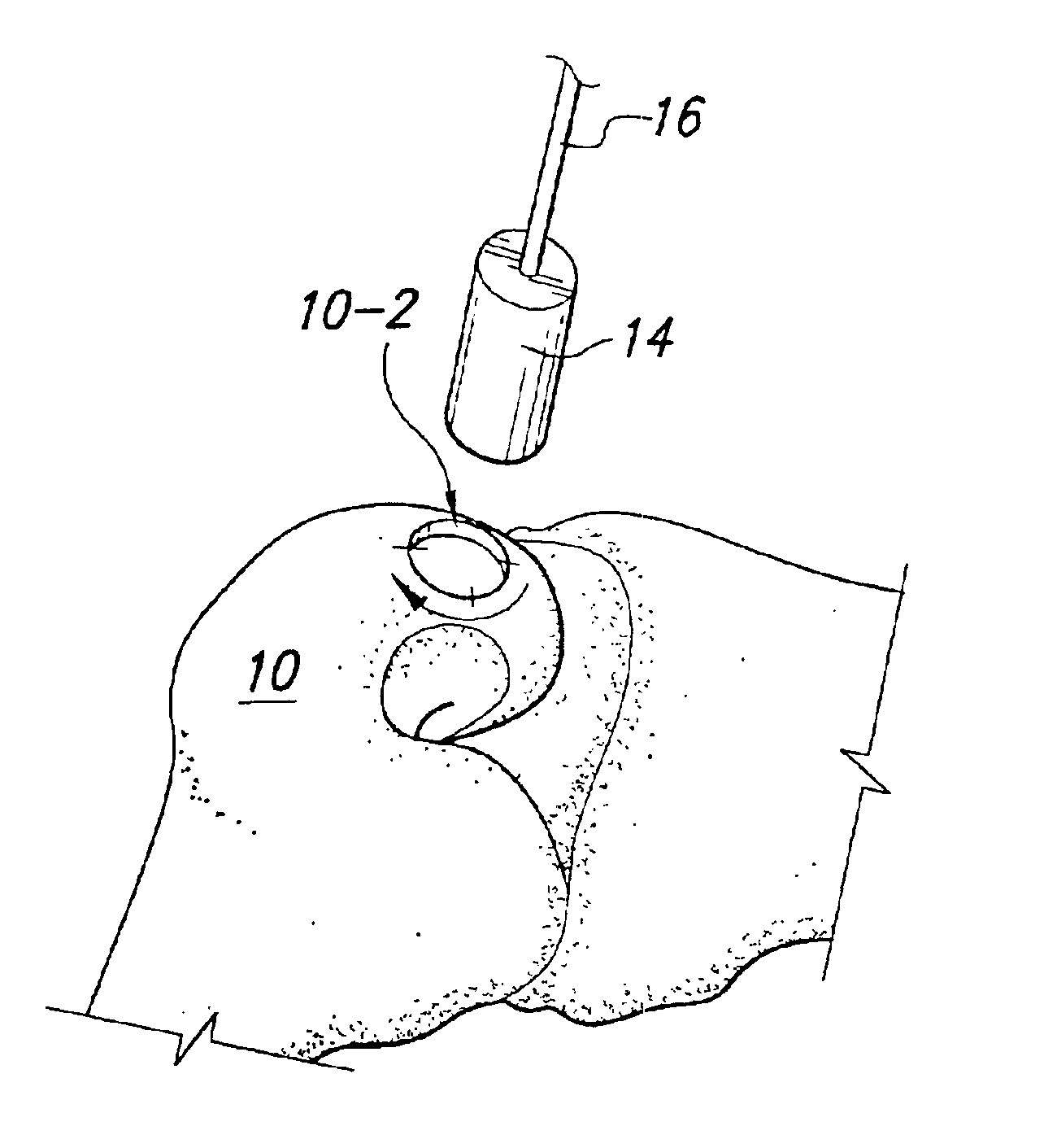 Osteochondral transplant techniques