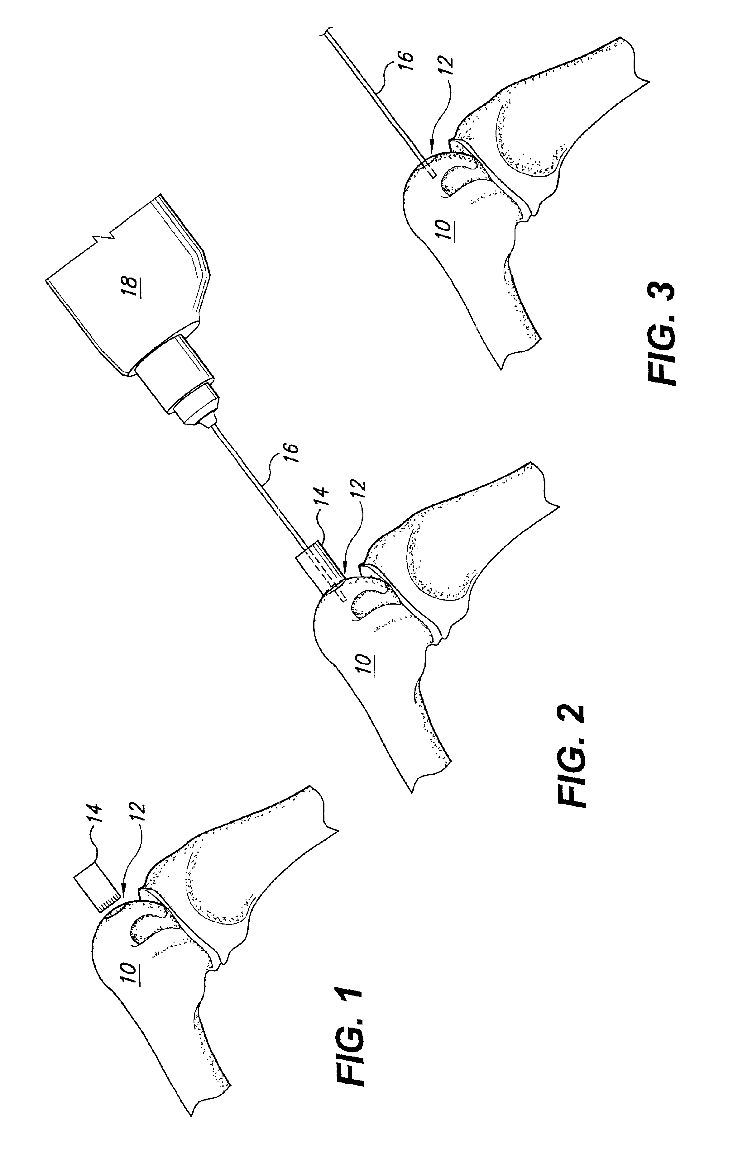 Osteochondral transplant techniques