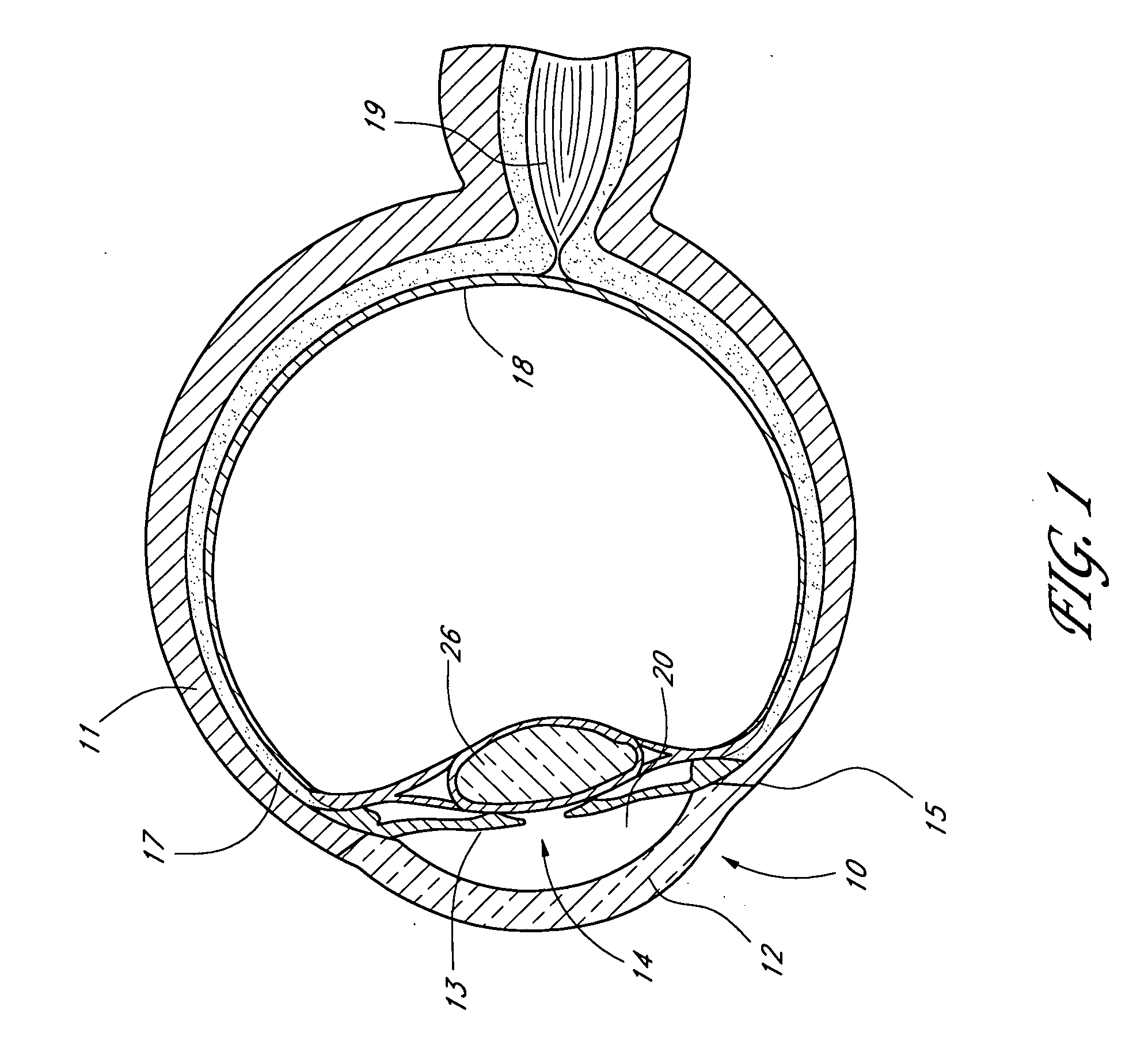 Glaucoma stent system