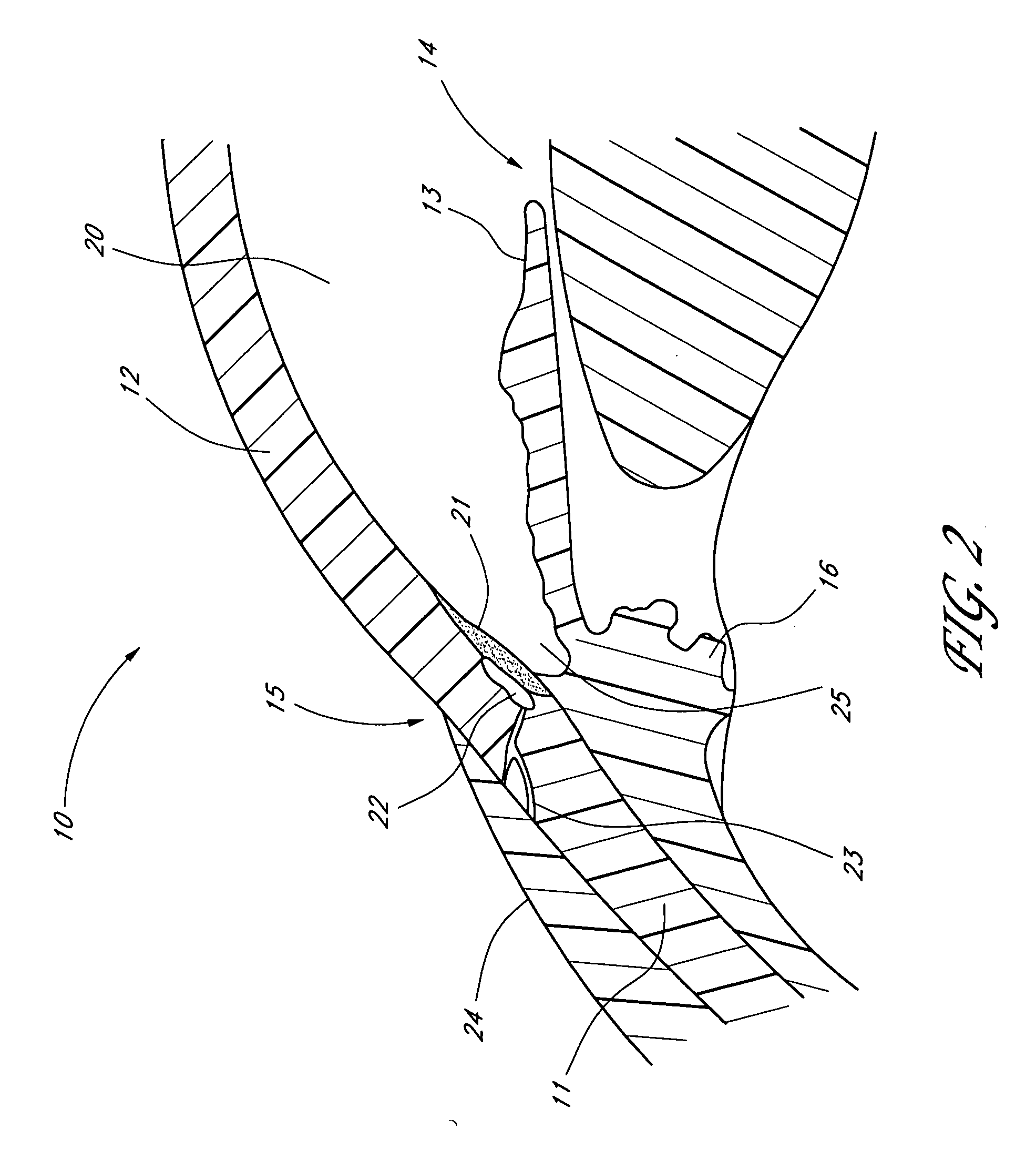 Glaucoma stent system