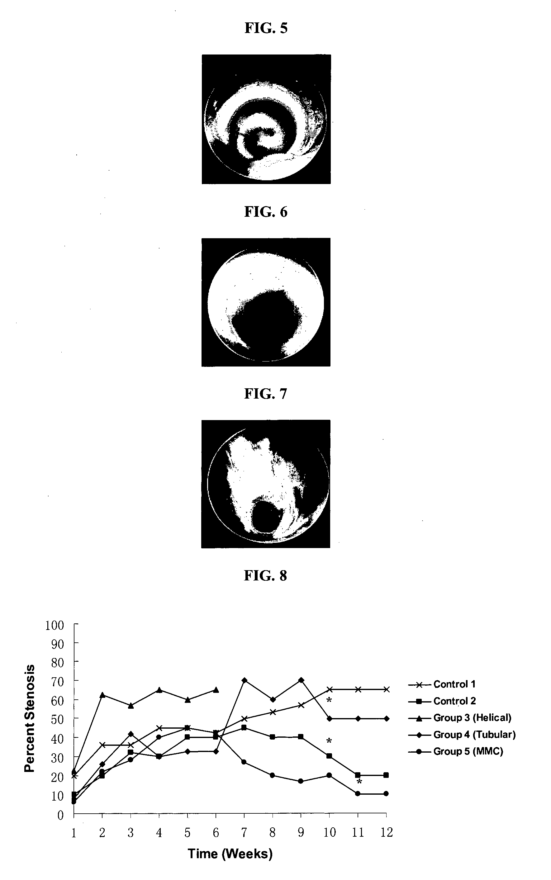 Bioabsorbable tracheal stent, and method of manufacturing thereof