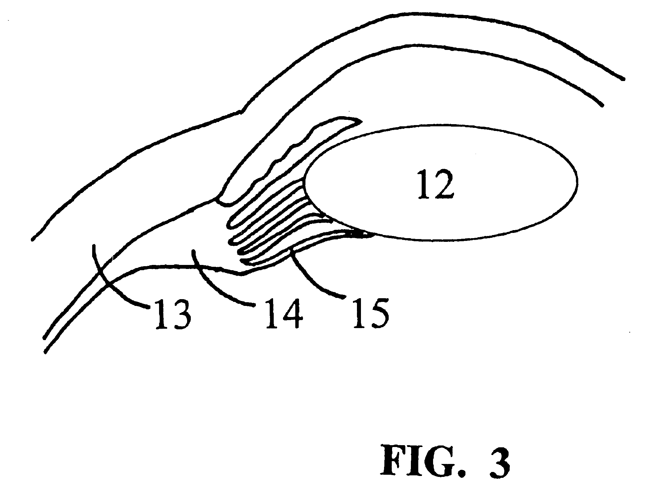 Treatment of presbyopia and other eye disorders using a scanning laser system